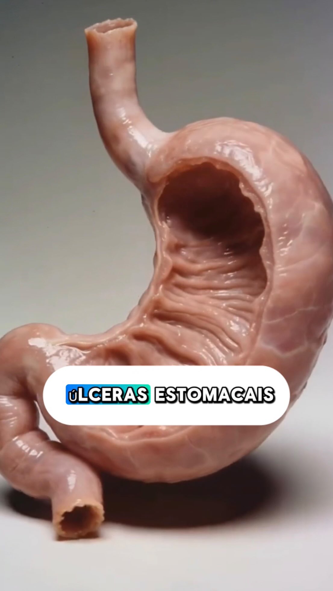 ⚠️ Dor no estômago, queimação, empachamento ou desconforto abdominal não devem ser ignorados.
Muitas pessoas convivem por semanas, meses — às vezes anos — com sintomas digestivos achando que “é só gastrite”… até que uma úlcera aparece ou evolui silenciosamente.
As úlceras do estômago podem surgir por diferentes causas, como infecção pela bactéria H. pylori, uso frequente de anti-inflamatórios, tabagismo, entre outros fatores. E o corpo costuma dar sinais antes de complicar.
Acompanhar esses sintomas com seu médico pode fazer toda a diferença entre tratar precocemente… ou lidar com complicações mais sérias.
🎥 Neste vídeo, mostro de forma visual como as úlceras se desenvolvem.
💬 Você ou alguém próximo já teve sintomas assim?
#Gastroenterologia #CirurgiaDoAparelhoDigestivo #SaúdeDigestiva #DorAbdominal #DorNoEstômago