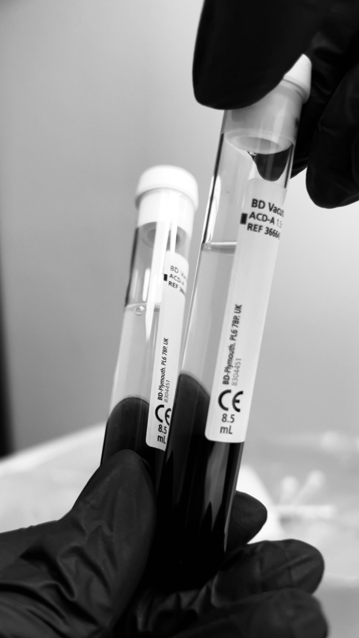 They call it *liquid gold* for a reason ✨
…but what actually makes it so powerful?
PRP (platelet-rich plasma) is taken from your own blood, spun to concentrate the most active components — the part your body uses to repair, regenerate and stimulate growth.
This is where the magic happens:
– Stimulates collagen + elastin production
– Speeds up skin healing and recovery
– Encourages hair growth at the root
– Improves overall skin quality over time
No fillers. No foreign substances.
Just your body, working smarter.
This is for you if you want results that feel like you, just better.
If you’ve been thinking about starting your skin or hair journey, this is your sign.
DM me “PRP” or book your free consultation via the link in bio.
#PRPLondon #HairRestorationUK #SkinRegeneration #AestheticsLondon #NaturalResults