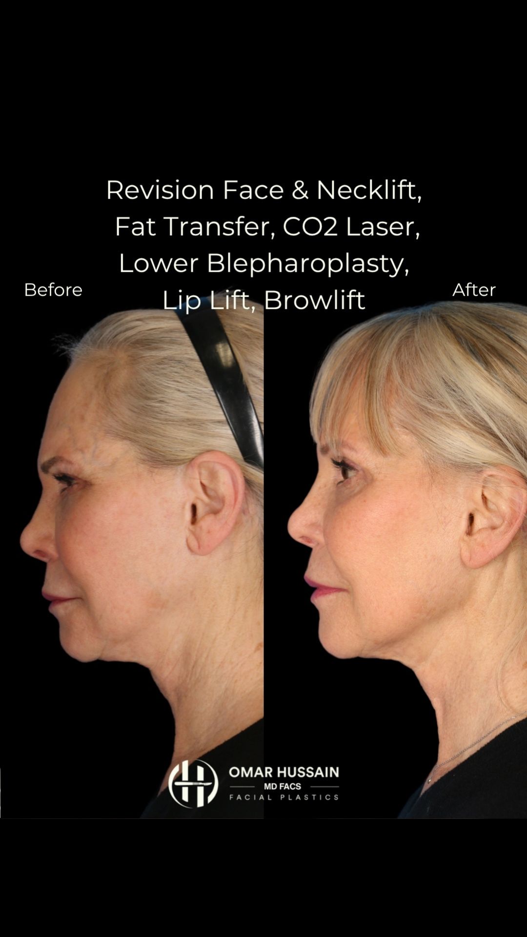 From tired to timeless — this stunning transformation included a revision facelift, necklift, CO2 laser, lower blepharoplasty, lip lift, browlift,
📍 Beverly Hills
📞 Call 310-278-8200 to schedule your consultation today.
#Facelift #PlasticSurgeryTransformation #Blepharoplasty #Necklift #beverlyhillsplasticsurgeon #CO2Laser #LipLift #BeforeAndAfter