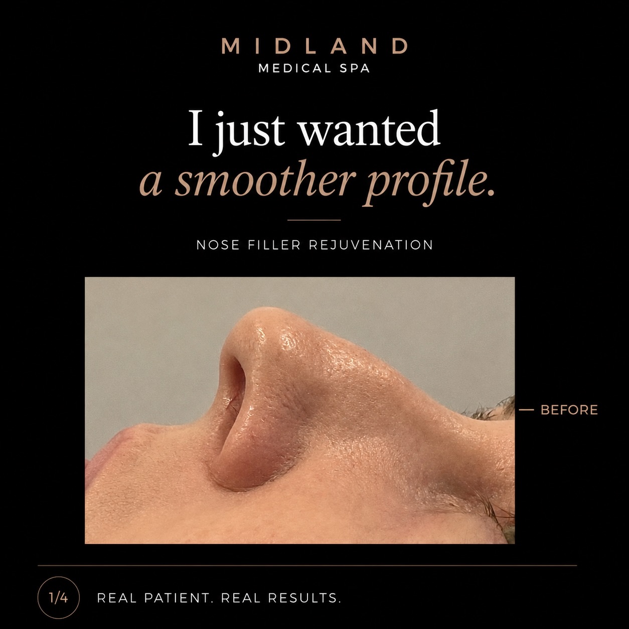 Subtle changes. Beautiful impact ✨
This nose filler transformation was designed to create better balance and profile harmony while keeping the result natural and refined.
Using carefully placed filler, we can help smooth bumps, improve definition, and create the illusion of a straighter profile — all without surgery.
The aim is never to completely change your features, but to enhance what’s already there 🤍
Every nose is different, which is why treatment is always tailored individually with safety and facial balance as the priority.
Thinking about non-surgical rhinoplasty?
DM to book your consultation 📩
#NoseFiller #NonSurgicalRhinoplasty #ProfileBalancing #NaturalAesthetics #AestheticClinic