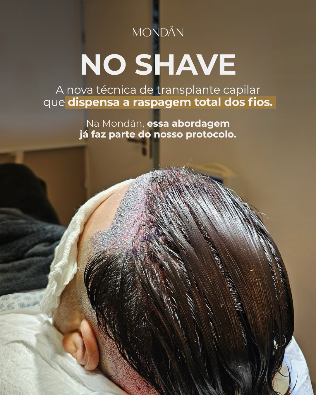 Você já pensou em fazer transplante capilar, mas desistiu por não querer raspar o cabelo?
Essa é uma das maiores barreiras para muitos pacientes.
A técnica NO SHAVE surge justamente como uma alternativa mais discreta, permitindo realizar o procedimento sem a necessidade de raspagem total.
O resultado? Um processo mais confortável e alinhado à sua rotina, sem expor o procedimento.
Na Mondän, avaliamos cada caso de forma individualizada para indicar a melhor abordagem.
Agende sua avaliação e descubra se essa técnica é ideal para você.