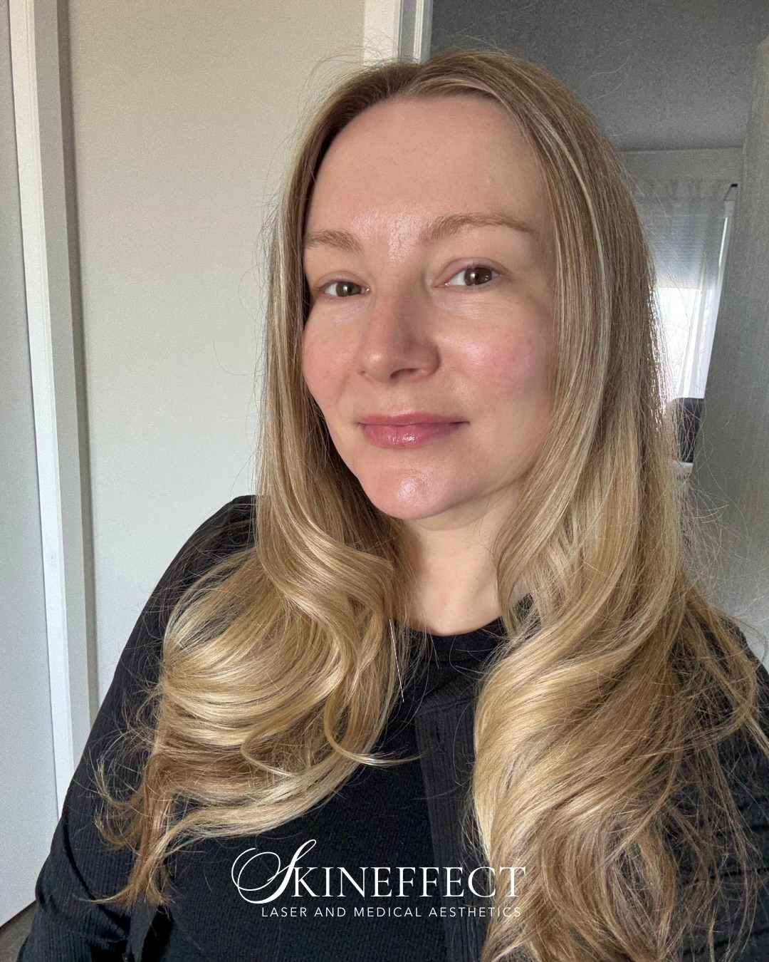 This is what consistency looks like. 🪄
Colleen’s routine isn’t complicated. It’s intentional; built around what her skin actually needs, not what’s trending.
She’ll tell you the results didn’t happen overnight.
They happened because she showed up for her skin, every day.
Save for skincare inspo ✨
#skincareessentials #medicalgradeskincare #medicalaesthetics #yegmedicalspa #glassskin