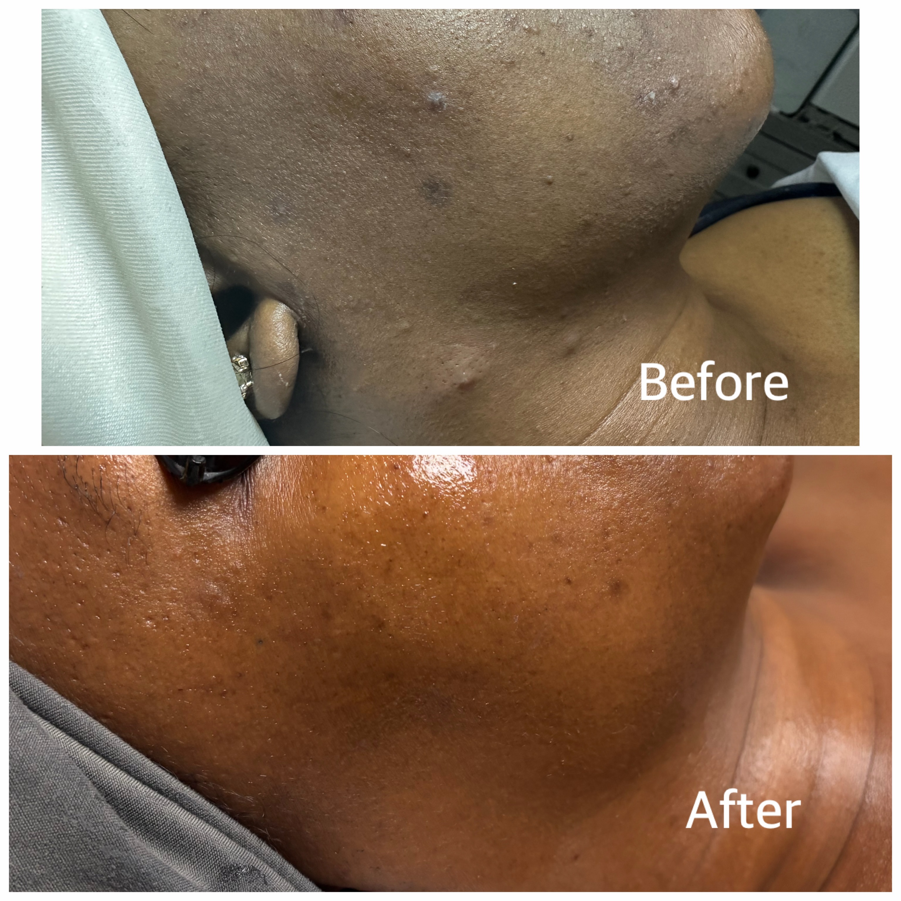 Before & afters speak for themselves! āØ
Consistent facials + customized at-home skincare can help improve acne, pigmentation, uneven skin tone, and texture for healthier, glowing skin. Your skin journey starts with consistency!
Book your DMV facial appointment or online skincare consultation today! š¤
#acnetreatment #facial #facialtreatment #rockvillemd #frederickmd