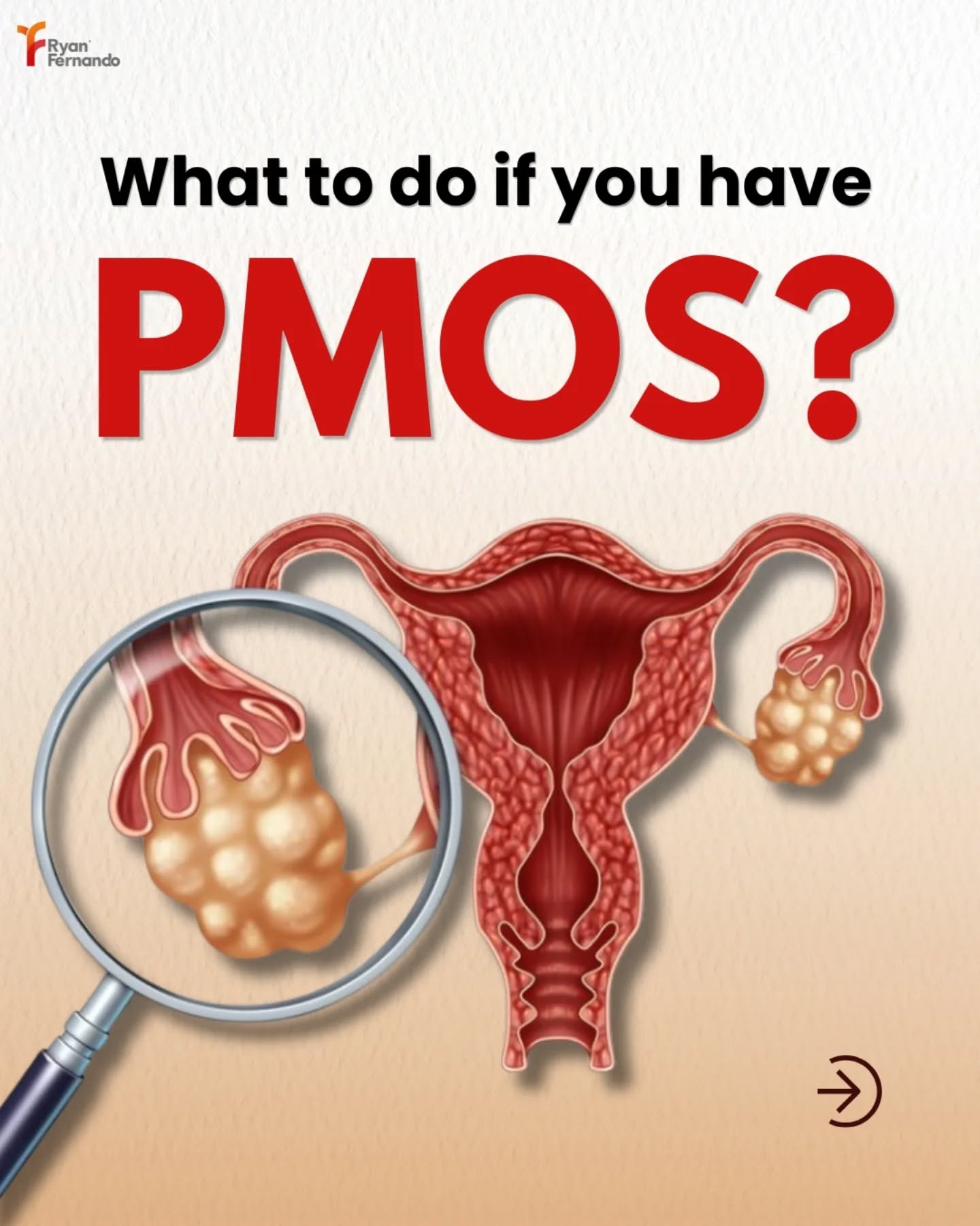 Recently, Poly Cystic Ovarian Syndrome (PCOS) has been renamed as Polyendocrine Metablic Ovarian Syndrome (PMOS), and many women are still struggling with issues like irregular periods, cravings, bloating, mood swings, weight gain, weight loss, acne, heavy bleeding, stomach pain, hair fall, and facial hair, without knowing where to start.
If you are also someone dealing with the same, this post will help you understand what to eat during each phase of your cycle. The right foods at the right phase can make a huge difference in how your body feels and functions. Watch till the end to support your hormones naturally through nutrition.
If you need help and if you are confused and need the guidance, then comment "Nutrition" to get your personalised diet plan.
.
.
.
#pmos #pcos #nutrition #instagram #india