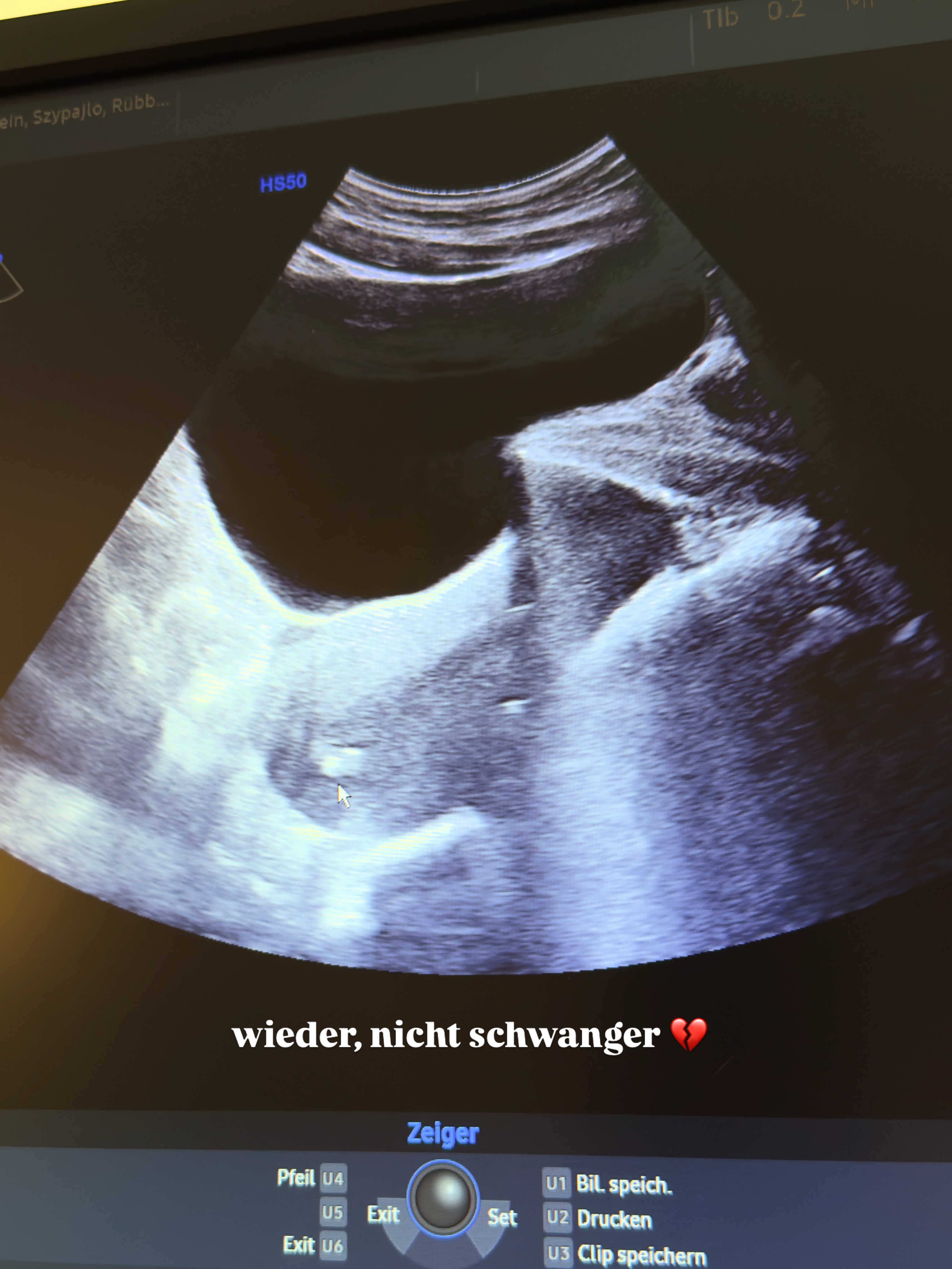 Ich wünschte es wäre anders, ich wünschte du wärst geblieben, ich wünschte ich wäre schwanger. 💔
Unsere 3. künstliche Befruchtung endete mit: NICHT SCHWANGER. Hab so viel geweint, dass könnt ihr euch nicht vorstellen. 😐
Die letzte Zeit war unfassbar turbulent. Ich brauchte diesmal deutlich länger, um das zu verarbeiten und bis heute tut es einfach unendlich weh. Der Transfer liegt schon etwas in der Vergangenheit im April, bevor ich die Reise mit euch teilen konnte musste ich es selbst erstmal stückweise verarbeiten. ✨
Ich hatte so ein gutes Gefühl, mein Gefühl hat mich getäuscht, ich habe kein Bauchgefühl mehr. 💔
#kiwu #unerfüllterkinderwunsch #kiwu #kiwucommunity #sad