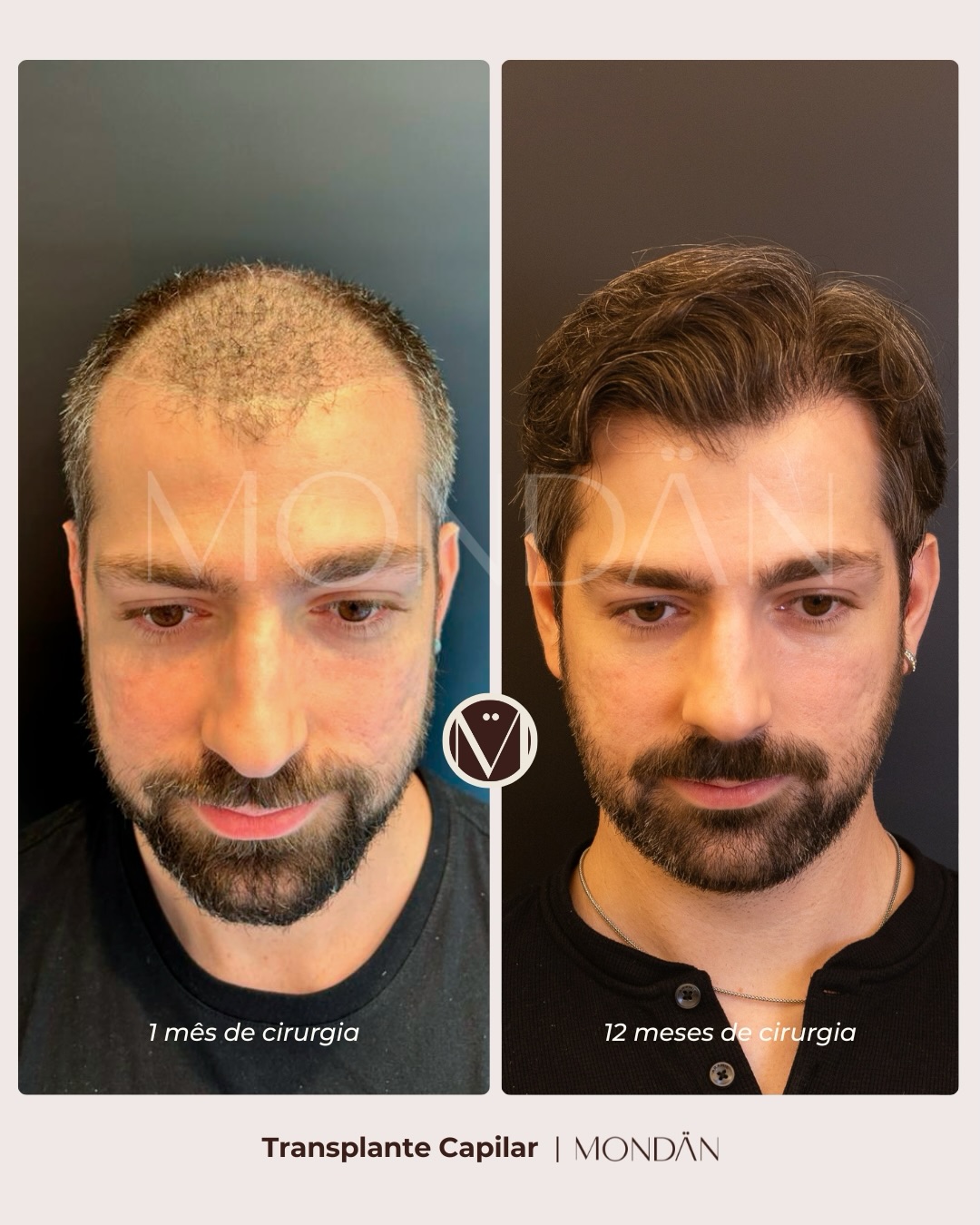 Resultado de transplante capilar realizado com técnica FUE.
As imagens têm finalidade educativa e demonstram uma evolução clínica individual, que pode variar de acordo com fatores como grau de calvície, área doadora, resposta biológica, cuidados pós-operatórios e planejamento médico.