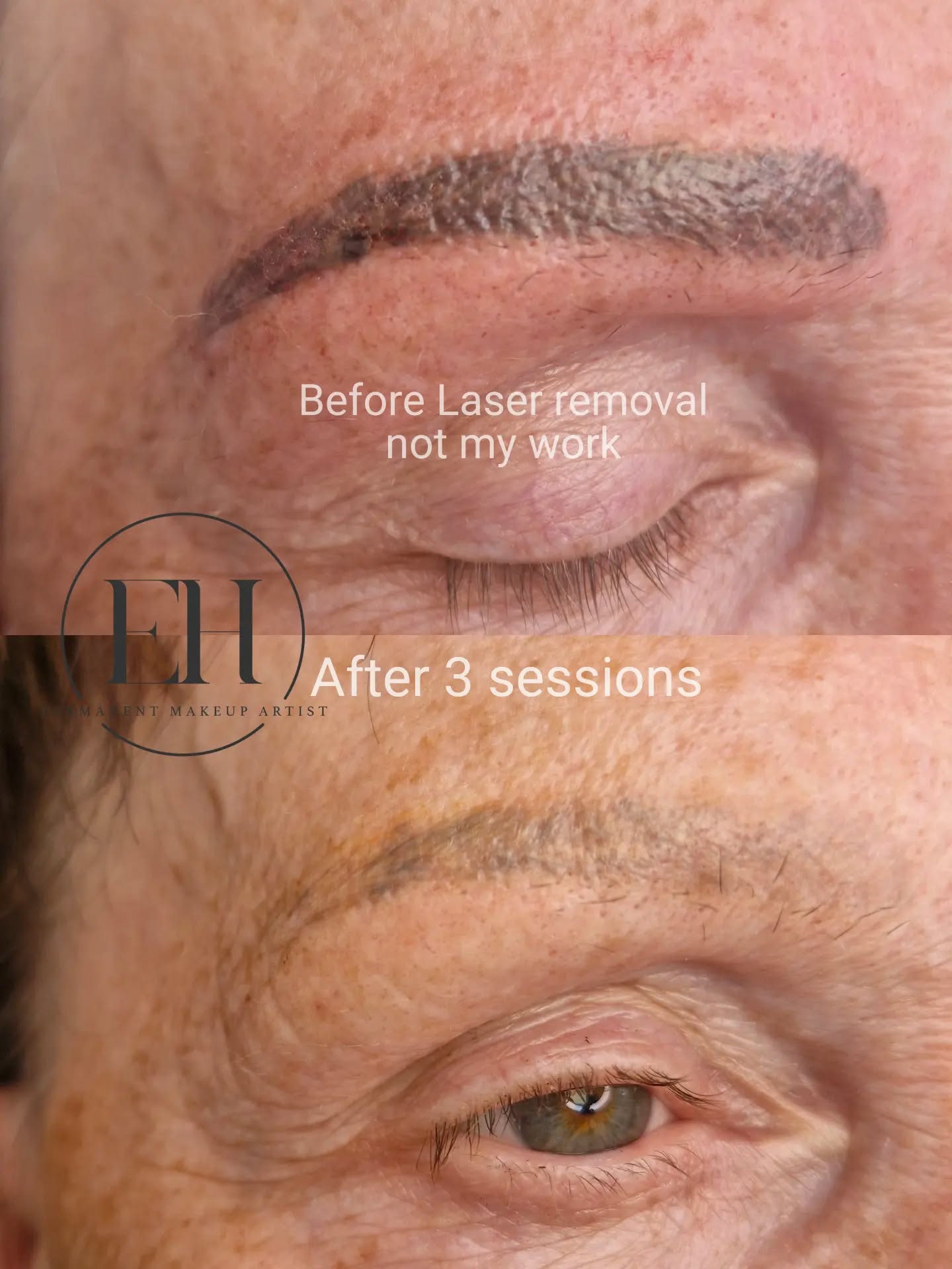 This lovely client came to me after having Microblading done elsewhere which unfortunately healed with a very strong, unflattering colour and blurred strokes that had merged together over time.
The pigment had been implanted quite deep into the skin, so this isn’t something that can be corrected in one quick session.
We’ve now completed 3 sessions of laser brow tattoo removal, spaced 8 weeks apart, and we are still patiently working through the journey. Removal is a process, especially when old permanent makeup has been saturated deeply into the skin, but every session is moving us closer to a softer, fresher canvas.
The goal?
Beautiful, soft Powder Brows that heal naturally and make her feel confident again
Sometimes the best results come from patience, trust and doing things properly rather than rushing the process.
#LaserTattooRemoval #BrowTattooRemoval #PowderBrows #PermanentMakeupCorrection #PMURemoval StAlbansBeauty