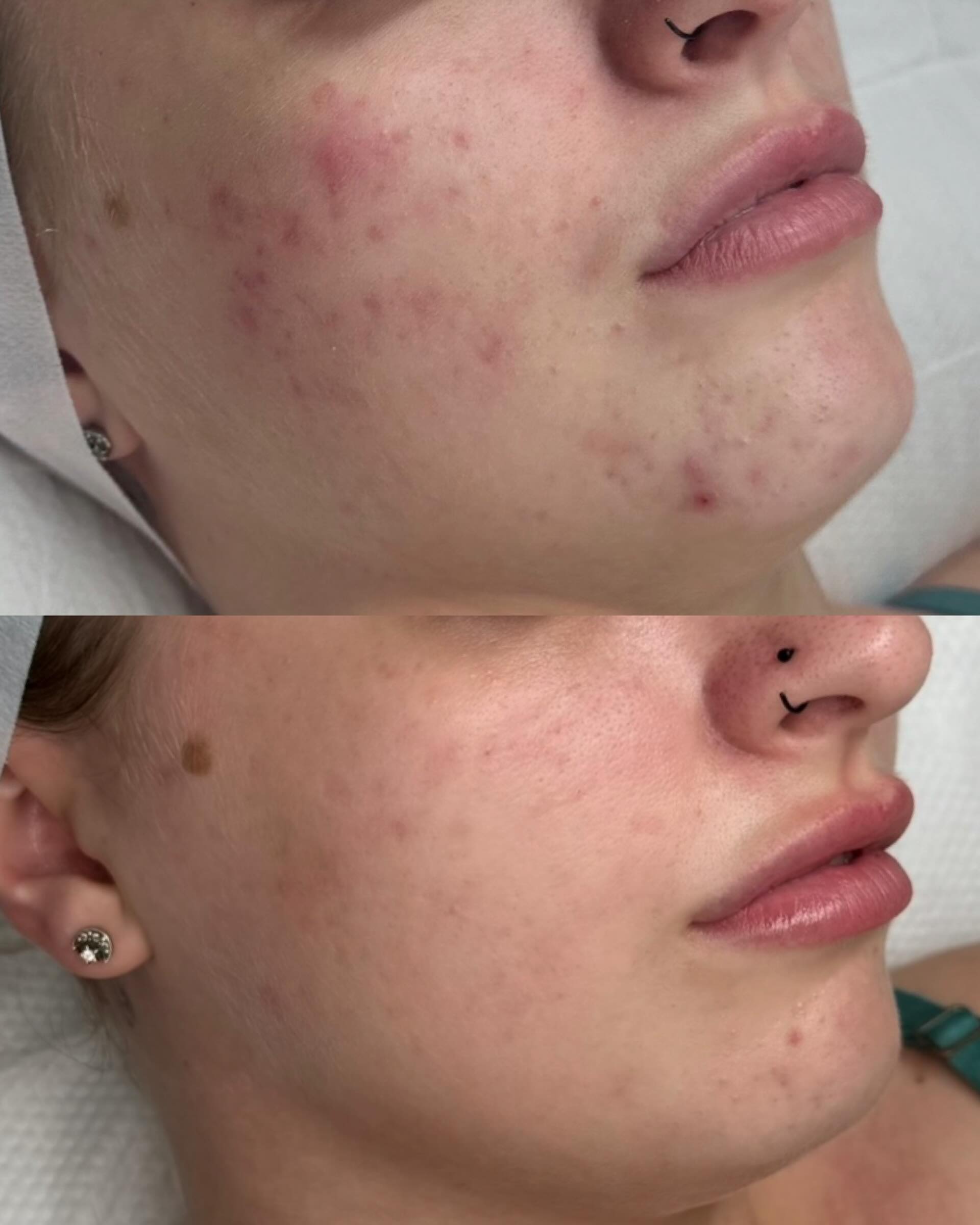 Still breaking out after trying EVERYTHING? Read this 👇🏼👇🏼
You’ve done the research, bought the products, followed the routines, maybe you’ve even had facials, tried the prescriptions, gone dairy-free for a month…
And your skin is still not clearing 😭
Here’s the uncomfortable truth nobody is telling you, you’re not failing your skincare routine.
Your skincare routine is failing you.
Because acne isn’t a surface problem. It never was 👀
This client came to me post-holiday, skin angrier than ever 😓
The old version of this story ends with a heavier prescription or another £40 serum. Instead? We stripped everything back and actually listened to what her skin was screaming.
Because inflamed skin = an inflamed body.
So we went after the real culprits:
🩸 Blood sugar spikes silently wrecking your hormones
😴 Poor sleep destroying your skin’s ability to repair itself
🧠 A stressed nervous system keeping your body in permanent fight-or-flight
🦠 A compromised gut microbiome showing up on your face
💧 Mineral deficiencies your moisturiser will never fix
We rebuilt her skin from the inside out.
The result? Less inflammation. Less congestion. More confidence. And, client who finally understands her skin instead of fighting it 💪🏼
If you’re still stuck in the cycle of product after product after product - I need you to hear this: your skin isn’t the problem. It’s the messenger. And until you stop silencing it with another spot treatment and start understanding what it’s telling you, nothing will change.
The product isn’t coming. But the answers?
I’m going to give them all to you 🫢
DM me “FREEBIE” and I’ll send you my FREE ebook - “Why Your Acne Isn’t Clearing (And What You’re Missing)” AND you’ll be first on the exclusive list for something brand new that’s coming in June…
Because you’ve spent long enough guessing. 👀✨
