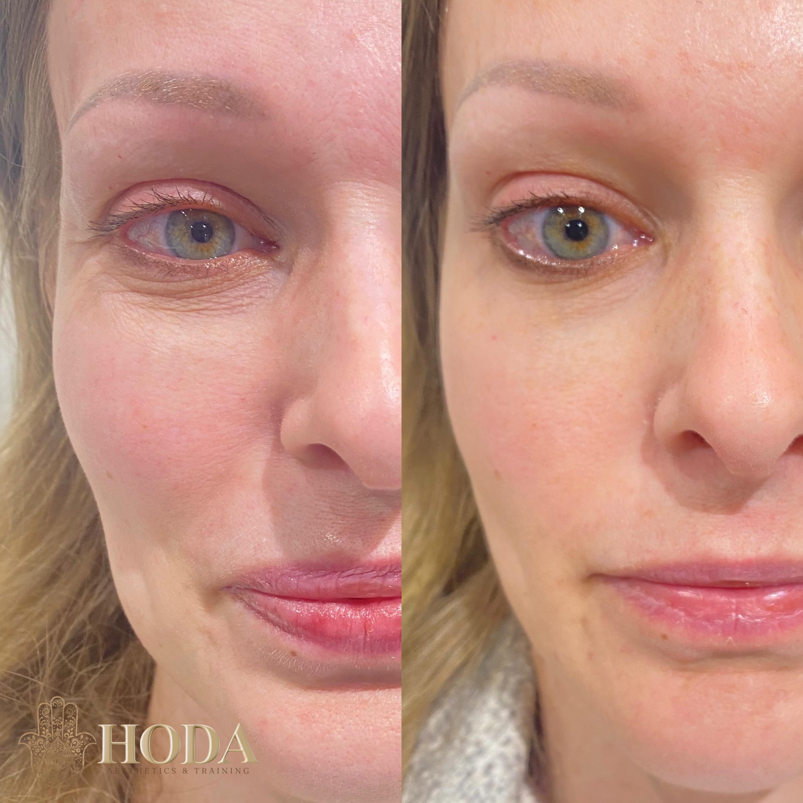 โจ UNDER EYE AND SKIN BOOSTER TRANSFORMATION โจ
Before & after results after 2 sessions of Lumi Pro Skin Booster ๐โจ
We have completed session 3 and I honestly canโt wait to see the final results develop over the next few weeks ๐
My client also had Illuma Luna Eyes treatment โ and the photo shown here is after just ONE session of Luna Eyes ๐โจ
For best results, a course of 3 sessions is recommended to achieve maximum hydration, brightening and skin rejuvenation.
๐ง Lumi Pro Skin Booster works by deeply hydrating the skin, improving elasticity, smoothing fine lines and restoring a healthy, radiant glow to the skin.
๐ Illuma Luna Eyes contains hyaluronic acid and polynucleotides to intensely hydrate and repair the delicate under-eye area, helping to reduce dark circles, improve skin texture, brighten tired eyes and soften crepey skin.
Already such a beautiful improvement in hydration, texture and brightness โ and weโre not finished yet ๐ Canโt wait to see the final results after session 3!
DM me to book yours ๐
#eyebooster #bournemouthskinclinic #bournemouthbeauty #dorsetaesthetic #pooleaesthetics