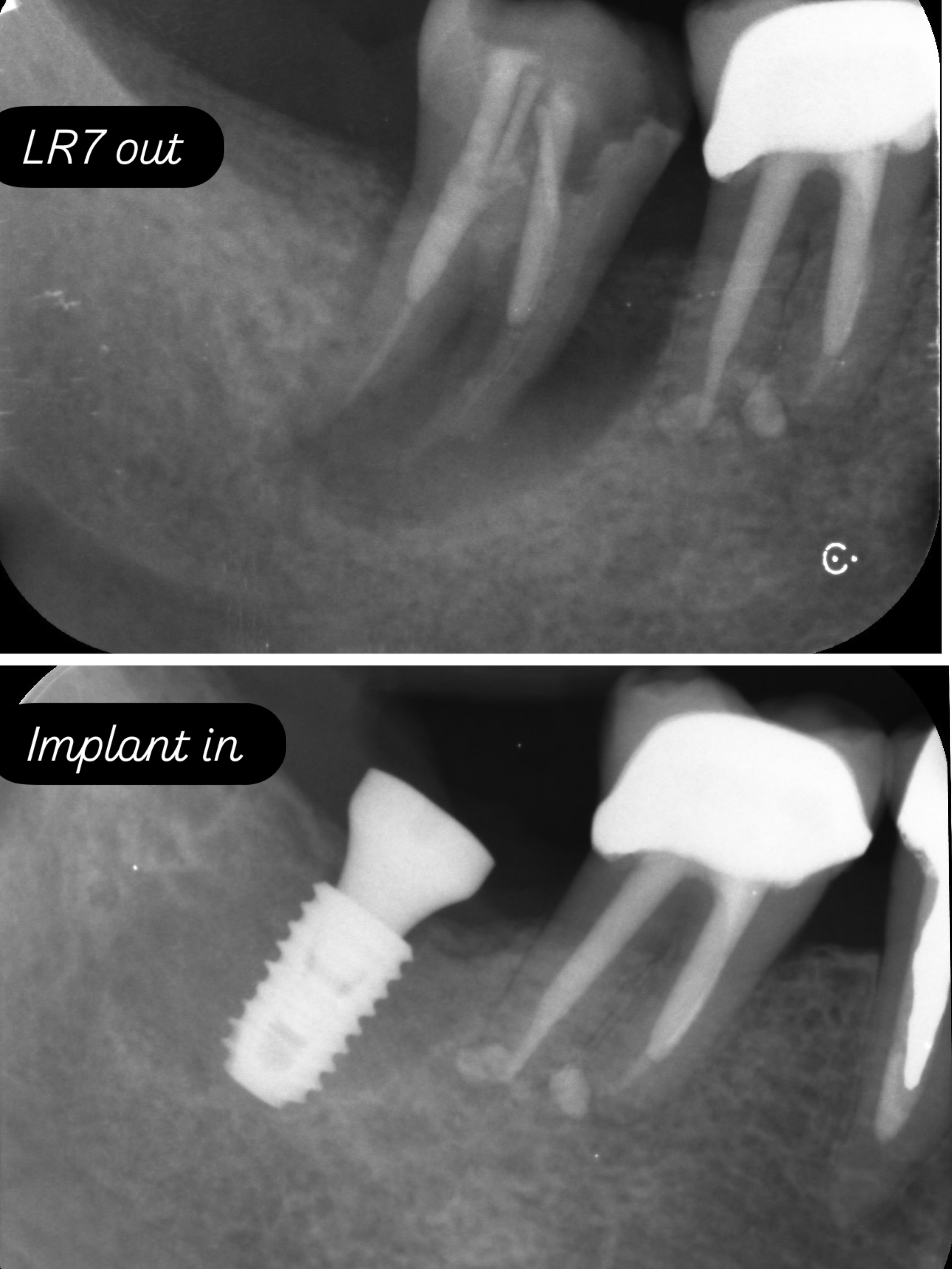 Heavily infected LR7 replaced with a dental implant #dentalimplantsurgery #dentalimplantsmanchester #dentalimplantsprestwich #restoringteeth #osstemimplants