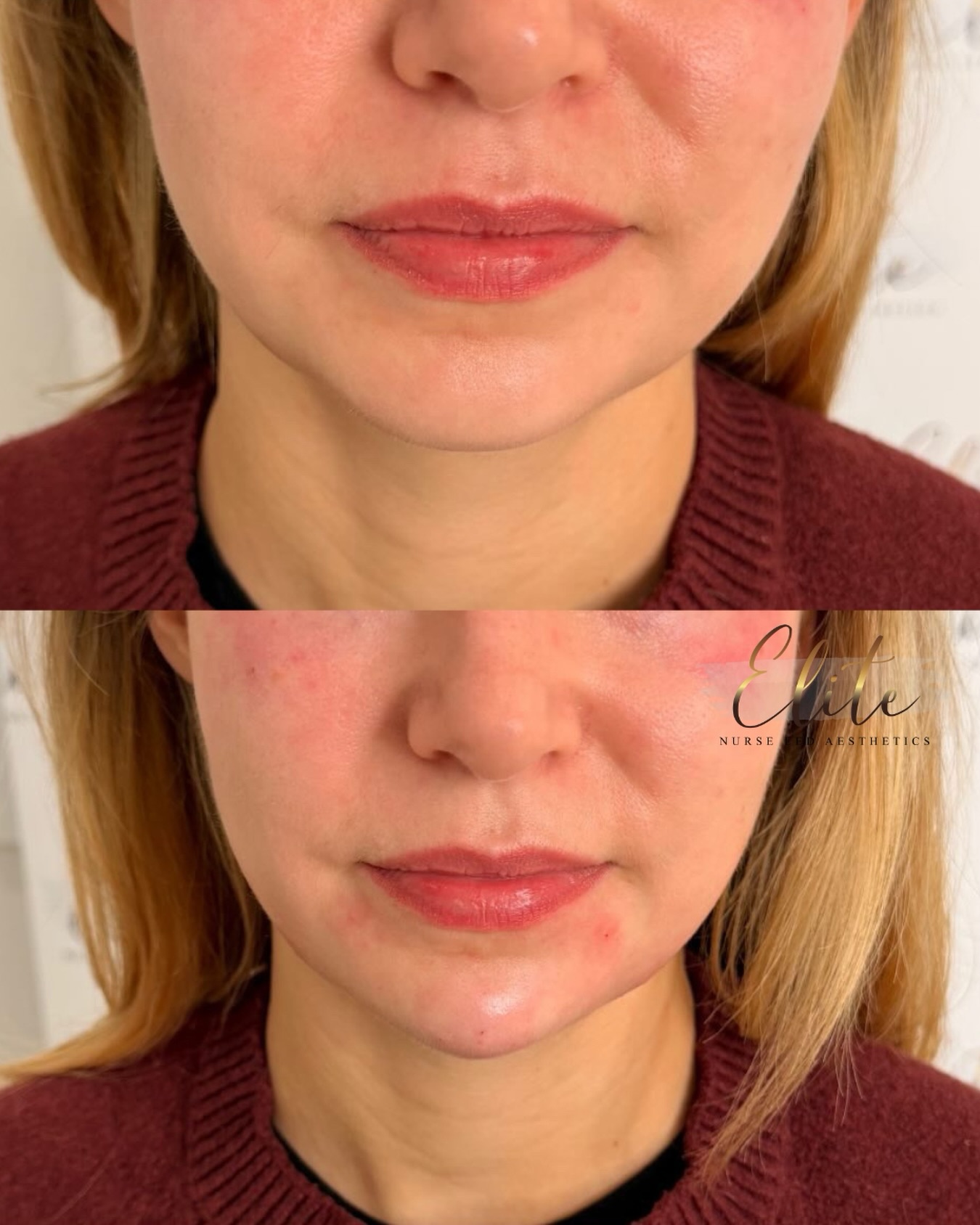 Chin Filler Transformation at Elite Nurse Led Aesthetics ✨
A subtle enhancement can make a huge difference 💉
Chin filler helps to create balance, definition, and harmony within the face — giving you a more sculpted and refined profile naturally.
Benefits of chin filler:
✔️ Enhances facial symmetry
✔️ Defines the jawline
✔️ Improves side profile
✔️ Creates facial balance
✔️ Non-surgical with instant results
Confidence starts with feeling your best
📍 Wakefield
📩 DM us today to book your consultation and begin your transformation with Elite Nurse Led Aesthetics.
#ChinFiller #WakefieldAesthetics #EliteNurseLedAesthetics #FacialBalancing #ProfileEnhancement