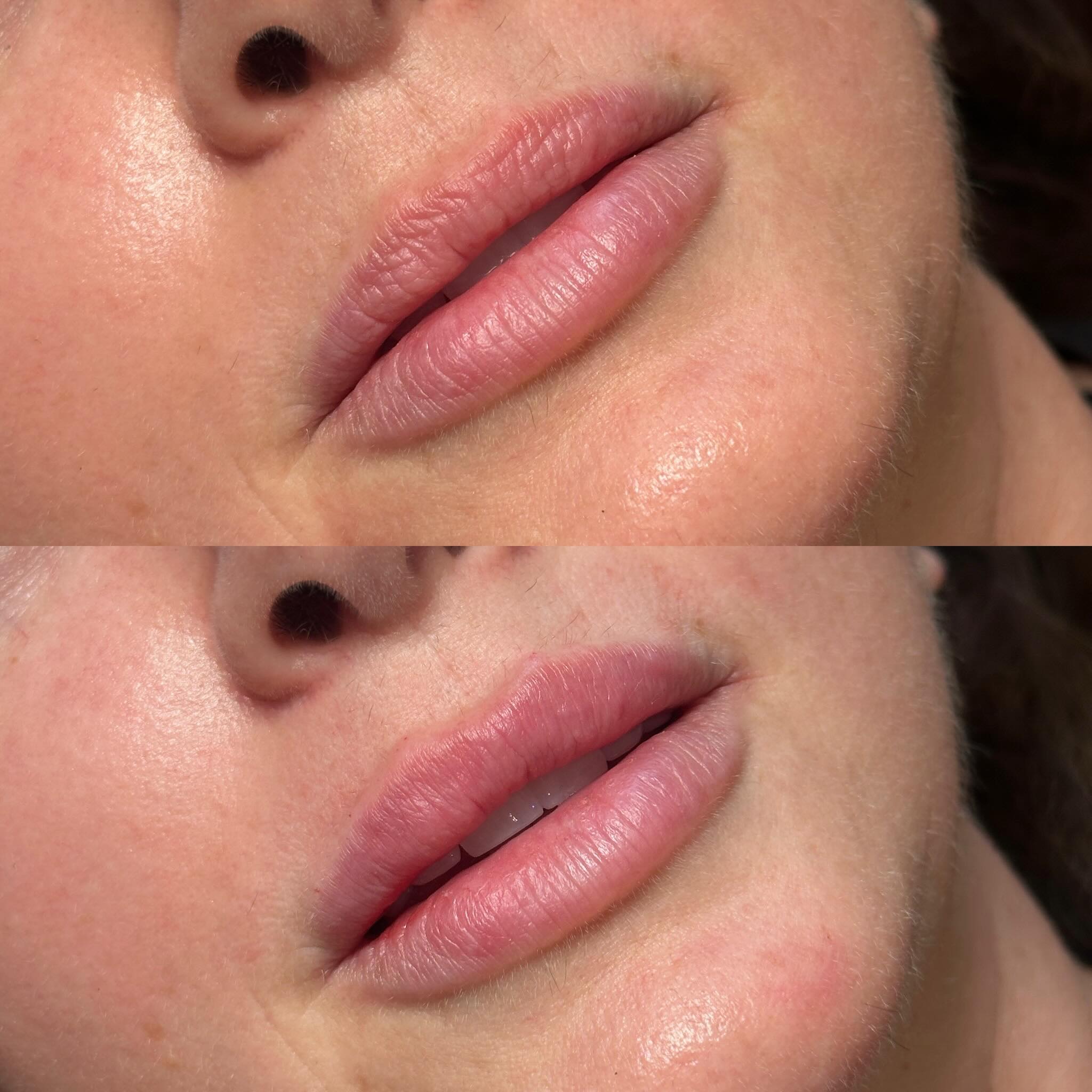Subtle yet significant, beautiful, and uniquely you. ✨ There’s a common myth that filler always equals “big” or “overdone,” but that couldn’t be further from the truth.
In reality, the best filler results are entirely undetectable. They don’t alter your face; they harmonize it. By combining the right product, precise technique, and a customized approach, we create enhancements so seamless that people will notice you look refreshed, but they’ll never guess why.