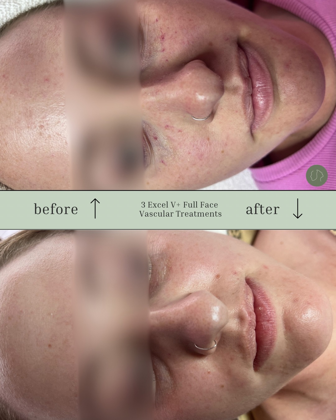 These results after just 3 Excel V+ Full Face Vascular treatments are exactly why we love what we do. Watching redness visibly calm and the complexion become clearer, brighter and more even is so rewarding, not just for us, but for the confidence it gives our clients in their own skin.
We are so lucky to have such incredible technology. If you’re ready to start your skin journey, we’re here to guide you every step of the way ✨
@cutera.anz