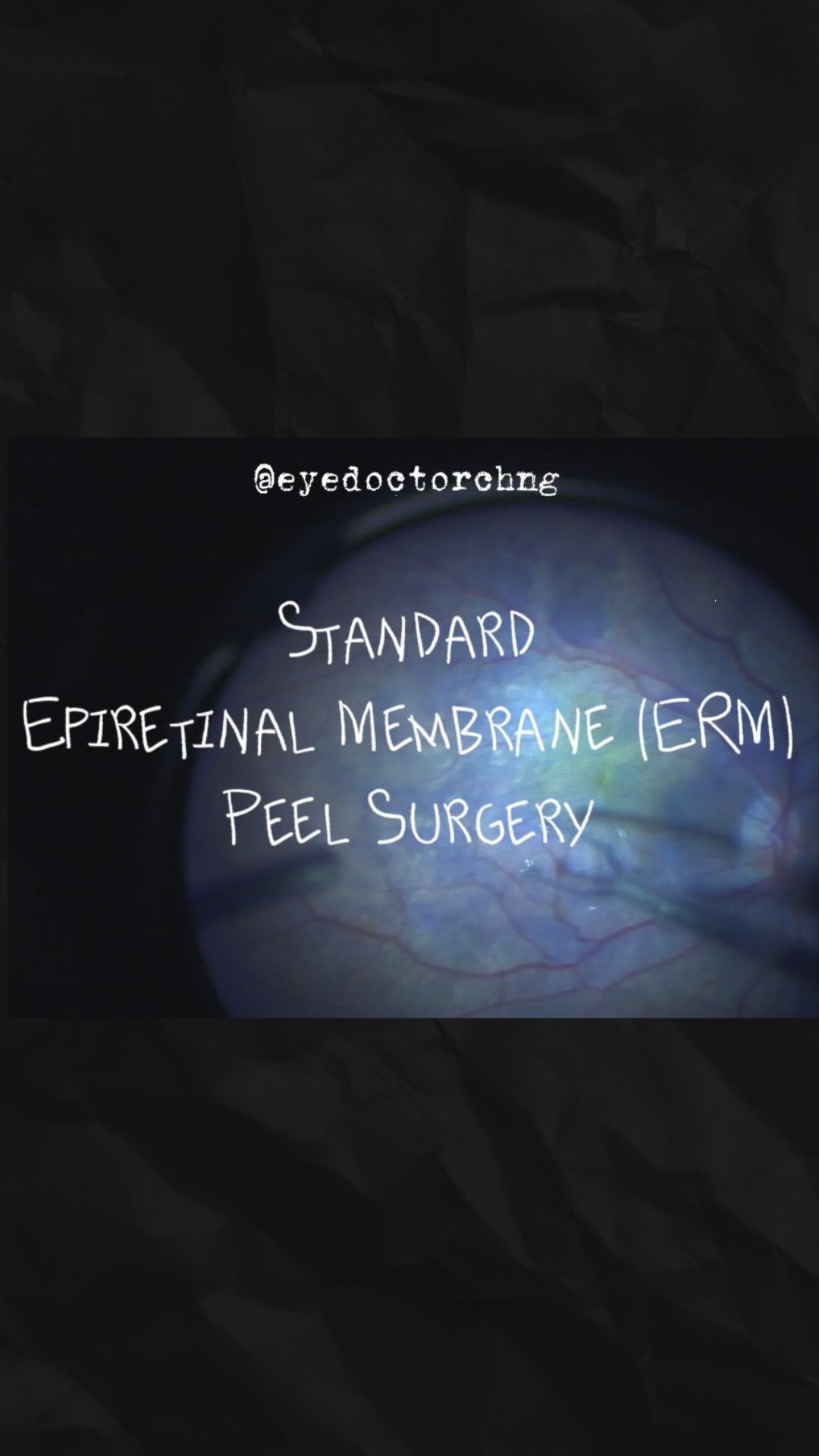 A routine standard epiretinal membrane peel during vitrectomy surgery.
#vitrectomy #ermpeel #vitreoretinalsurgery #retina #eyedoctorchng