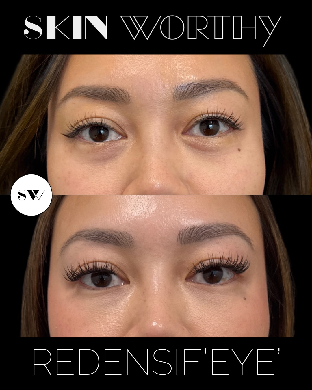 One RedensifEYE treatment ✨
A beautiful option for refreshing the under-eye area with little to no downtime. RedensifEYE helps improve the look of brightness, hydration, and skin quality — without adding volume.
This is a great alternative for those who want a fresher, more rested appearance without traditional tear trough filler.
Subtle, hydrated, refreshed. 🤍
Ideal for patients looking to improve under-eye skin quality rather than create volume.