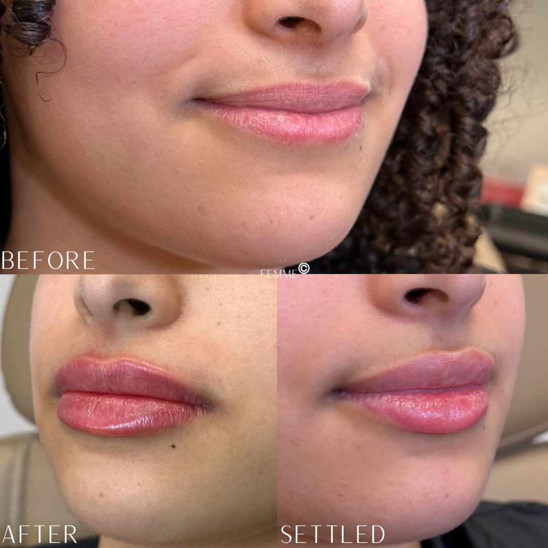 Lips are a process, not a one-moment result
• Before: little structure, limited shape, volume not balanced
• Immediately after: fuller, yes—but also swollen (this is not the final result)
• 2 weeks later: swelling resolved, shape refined, lips soft, balanced, and natural
This is why patience matters. The goal is never just “bigger”… it’s proportion, structure, and harmony with your face.
Good work shouldn’t look obvious—it should look like you, just elevated.