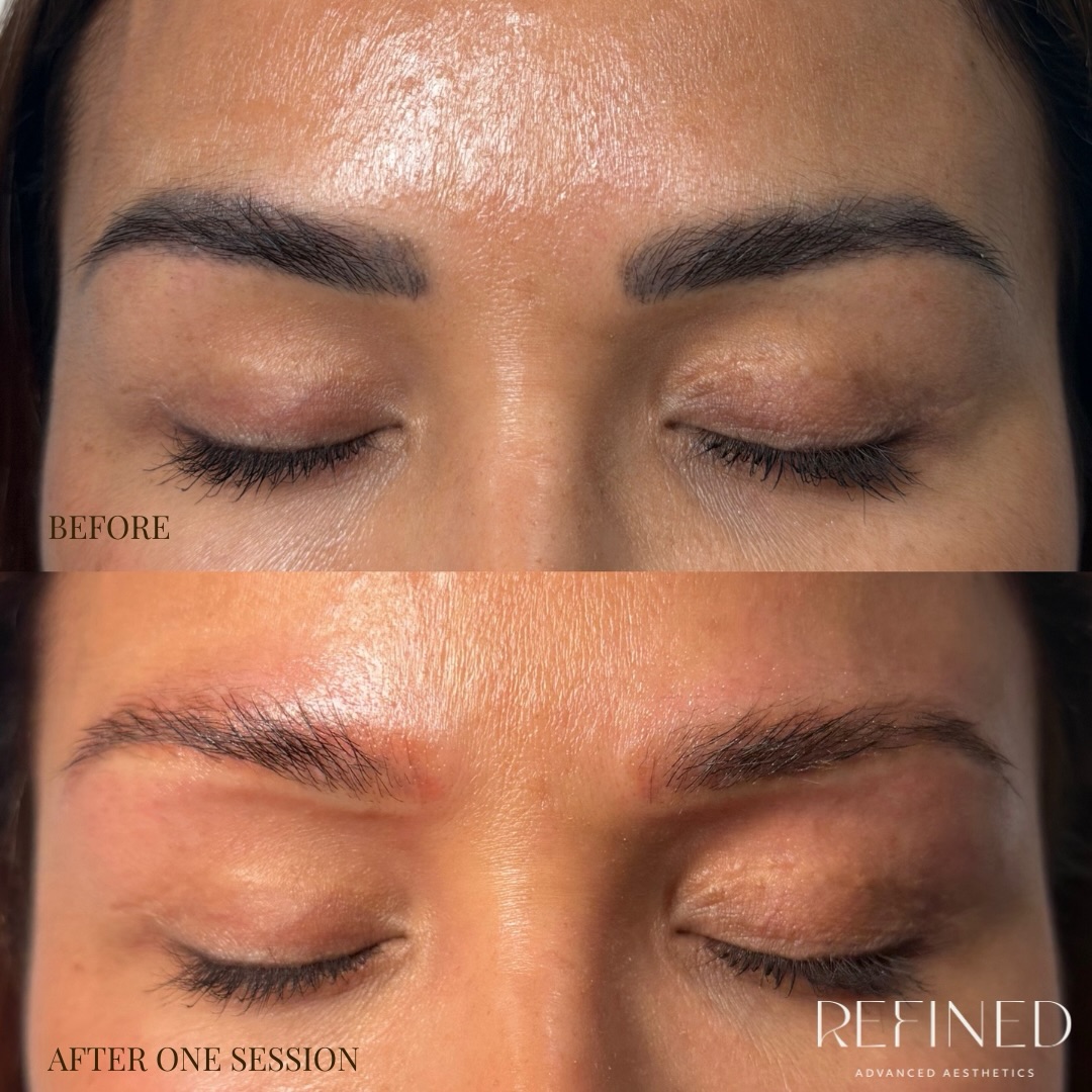 The results speak for themselves ✨
even after just one session of laser tattoo removal, there is already visible fading and a noticeable reduction in pigment intensity, showing the treatment is effectively breaking down the ink, showing a more natural look 🤍