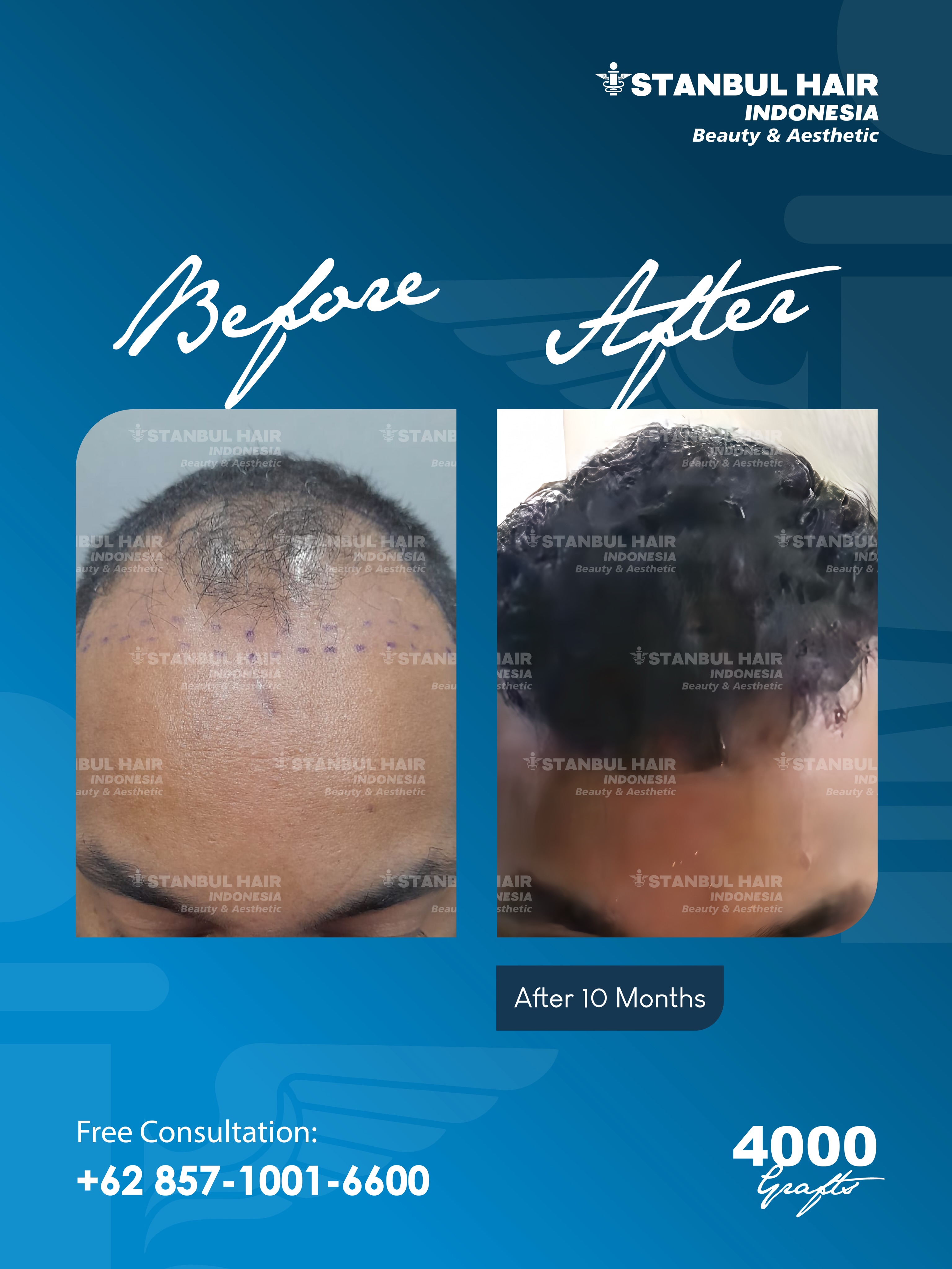 Hasil 10 bulan pasca hair transplant dengan 4000 grafts ✨
Perubahan terlihat semakin maksimal dengan kepadatan yang lebih merata dan hairline yang tetap natural.
Setiap progres adalah hasil dari teknik yang presisi dan penempatan graft yang optimal.
Konsultasi GRATIS tersedia untuk Anda.
—
10-month progress after a 4000 grafts hair transplant ✨
The transformation appears fuller with improved density and a natural-looking hairline.
Every result comes from precise technique and optimal graft placement.
Free consultation available.
#HairTransplant #4000Grafts #HairRestorationJourney #NaturalHairline #HairTransplantResult
