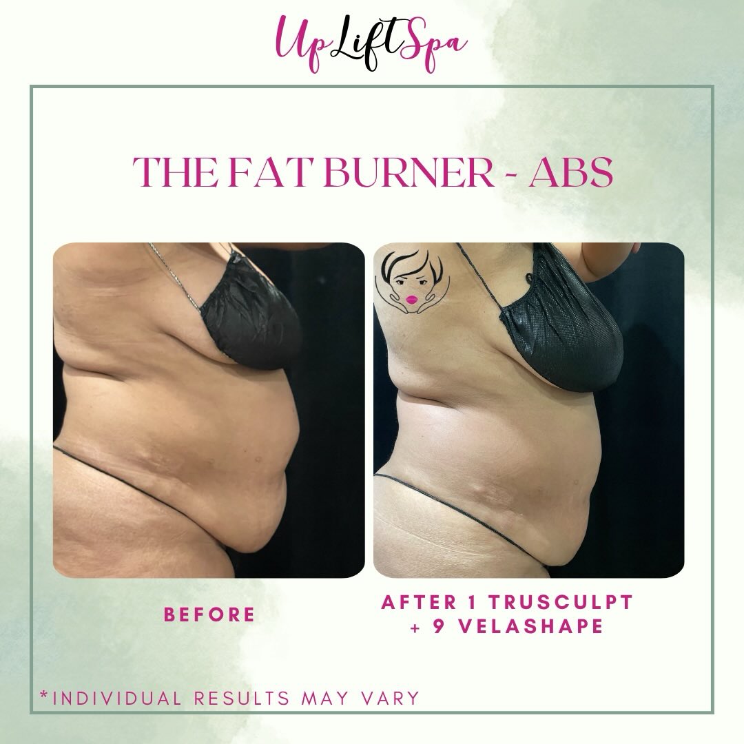 ✨ Real results, real confidence ✨
This is what consistency + the right treatments look like.
Targeting stubborn areas, smoothing skin, and redefining your shape — no surgery, no downtime.
Our custom Fat Burner Duo works deeper than just surface-level changes… it’s about feeling comfortable in your own body again.
📲 Ready to start your transformation? DM me “ABS” and let’s build your plan.
#bodycontouring #trusculptid #velashape #nycmedspa