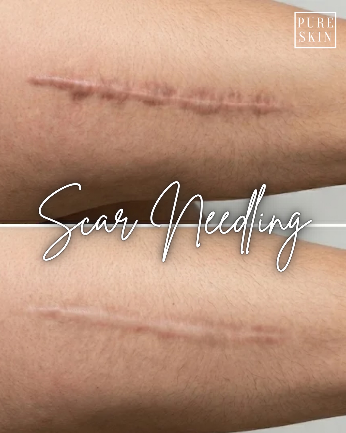 Skin revision at a cellular level. âš
Standard facial microneedling refreshes the surfaceâbut Scar Relaxation Needling is a deep, structural treatment engineered to break down and reconstruct dense, rigid scar tissue.
Using a precision device paired with NueConceal Regenâa premium, medical-grade amino acid and collagen complexâwe target tight fibrotic bands to replace hard scar tissue with smooth, flexible skin.
The Results:
+ Softens & Relaxes: Restores movement to tight, restricted scars.
+ Smooths Texture: Flattens raised ridges and lifts uneven indentation.
+ Balances Color: Calms dark areas and wakes up natural tone in white scars.
+ Preps for Camouflage: Creates a soft canvas for flawless pigment blending.
+ Perfect for surgical lines, stretch marks, or trauma scars.
ð» Ready to restore your skin? Visit our site for more info (link in bio)
#ScarRevision #InklessScarRevision #NueConceal #ScarNeedling #ParamedicalTattooing SurgicalScar CsectionScar TummyTuckScar MaynardMA