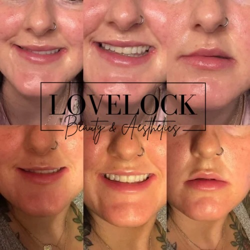 A Tox Lip Flip is a quick, non-surgical treatment designed to subtly enhance the appearance of the upper lip. By relaxing the muscles around the lip, it helps the top lip gently roll outward, creating a fuller-looking shape without adding volume. Benefits can include improved lip definition, reduced “gummy smile,” and a more balanced, natural-looking pout with minimal downtime. Perfect for clients wanting a soft, subtle enhancement 💋
#warminster #trowbridge #westbury #melksham #frome