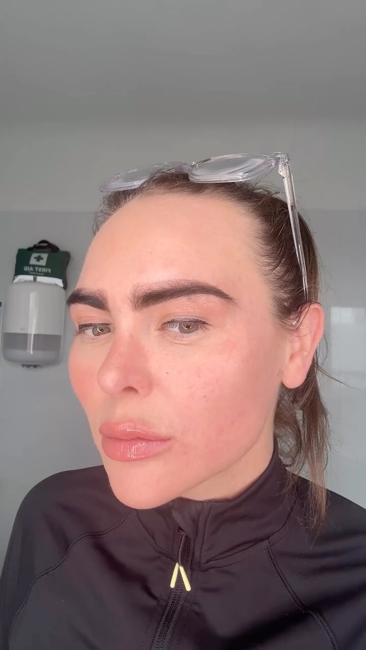 Mid-face vs lateral cheek filler… same treatment, different purpose.
• Mid-face → restores volume loss
• Lateral cheek → lifts and supports ligaments
• Correct placement = natural rejuvenation
Understanding facial anatomy and vector lifting is what separates average results from exceptional ones.
#aesthetictraining #aesthetic #aestheticclinic #skinclinic #antiaging