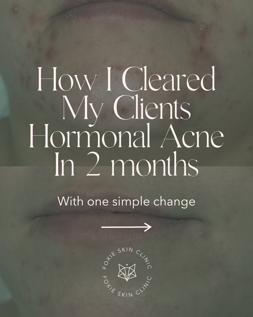 Hormonal acne isn’t always a skincare problem, sometimes the trigger is hiding in your daily habits 👀
This client’s skin completely transformed once we identified what was driving the inflammation internally, not just what was happening on the surface ✨
If you struggle with hormonal breakouts every month, DM “ACNE” and I’ll send you my FREE acne e-book + add you to the exclusive list for something exciting coming very soon that you NEED to be part of 🤍