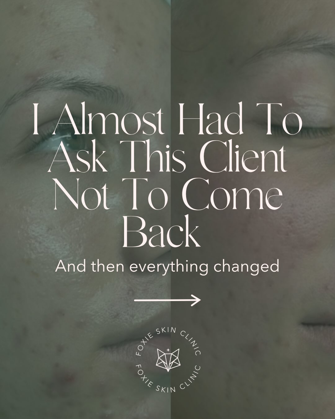 This one humbled me 🫠
I threw EVERYTHING at this client’s skin. We looked at skincare, treatments, diet, supplements, stress, sleep, and instead of improving, her acne just kept getting worse 😭
I genuinely started questioning myself.
But one conversation changed everything. We uncovered something that had been completely overlooked and suddenly all the pieces started fitting together 👀
This is your reminder that acne isn’t always about finding another product, another facial, or another treatment. Sometimes it’s about finding someone who will actually listen and help you connect the dots 🤍
If you feel like you’re doing “everything right” and your skin still isn’t improving- DM me “FREEBIE” and I’ll send you my FREE e-book + get you onto the exclusive list for what’s coming next ⚡️