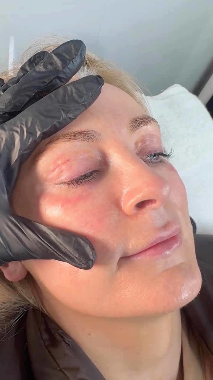 Polynucleotides are not about adding volume… they’re about rebuilding your skin from within.
This is regenerative aesthetics.
Stimulating fibroblasts.
Increasing collagen + elastin.
Improving skin thickness.
Restoring elasticity.
Repairing damaged tissue.
Perfect for:
• Under-eye crepey skin
• Acne scarring
• Ageing neck
• Sun-damaged skin
• Clients who don’t want more filler
The goal isn’t bigger.
It’s healthier. Stronger. More resilient skin.
This is collagen banking done properly.
Comment “REGEN” if you want to know if you’re suitable ✨
#Polynucleotides #skinclinic #antiaging #skincareroutine #aesthetics