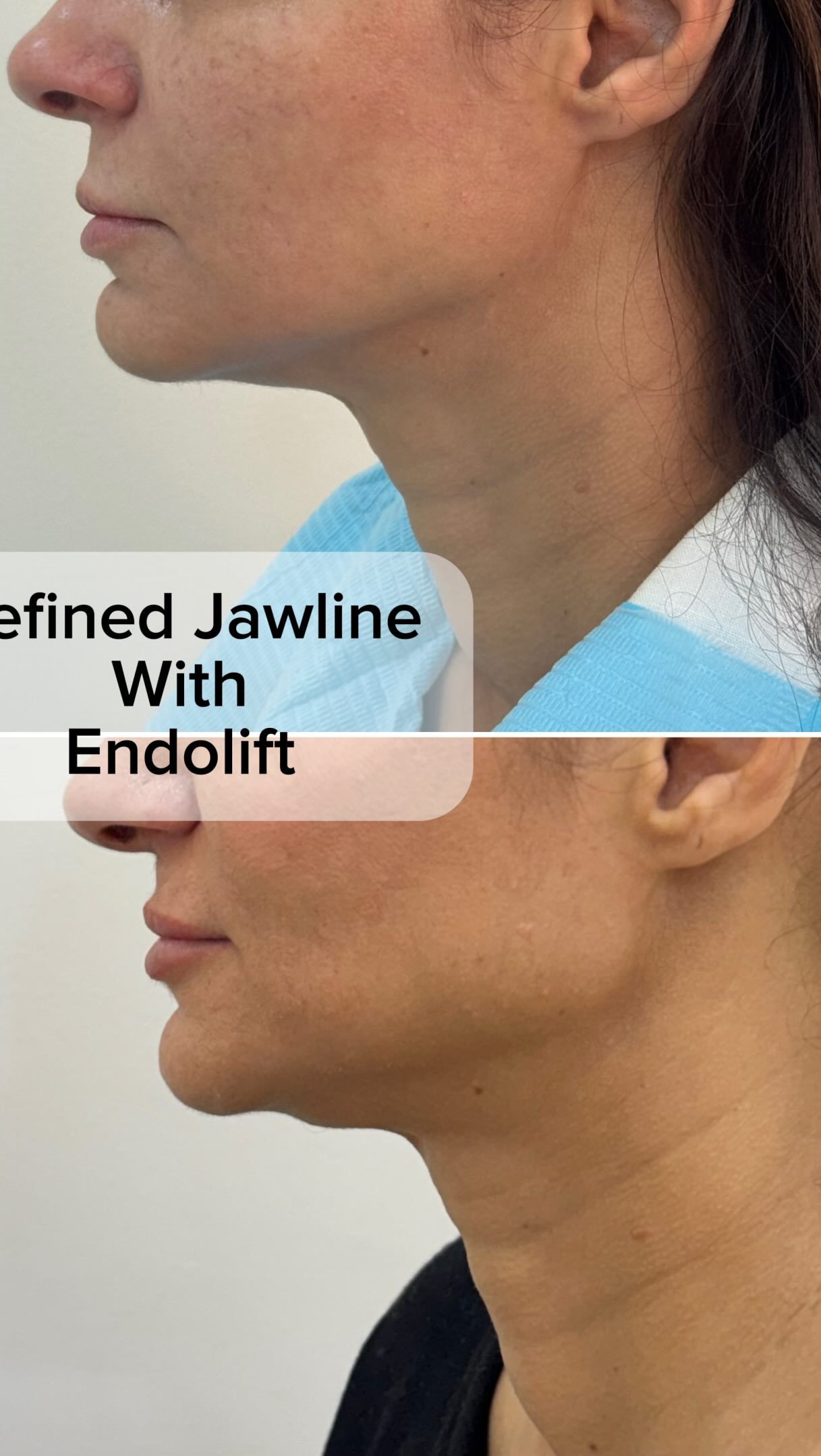 Endolift for More defined Jawline
If:
🔺 you have Mild to Moderate fat and skin laxity ✅
.
.
.
#endoliftdubai #endolift