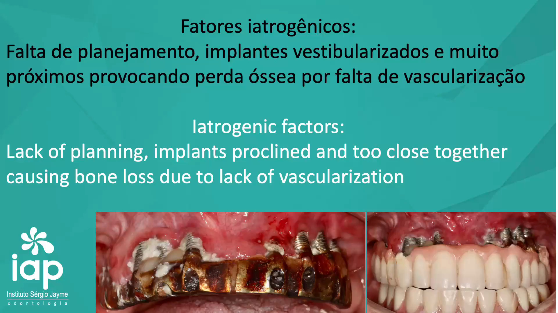 Fatores iatrogênicos:
Falta de planejamento, implantes vestibularizados e muito
próximos provocando perda óssea por falta de vascularização
Lack of planning, implants proclined and too close together
causing bone loss due to lack of vascularization
O planejamento inicial, protético e cirúrgico, resultará em sucesso ou fracasso no tratamento final do seu paciente.
Nesse caso a falta de planejamento e bom senso foi muito grande, foram instalados 10 implantes vestibularizados e muito próximos entre eles gerando falta de vascularização e como consequência, perda óssea.
Foram removidos 7 implantes e mantidos 3 distais. Foi usada a técnica do All on 4, tangenciando os seios maxilares evitando grandes reconstruções ósseas.
Cirurgia realizada no IAP-Sérgio Jayme
Dr. Sérgio Jayme Av. Paulista, 91 Cj 402
Tel (11)5572-1283 / Cel e WhatsApp (11)94888-2000 CEP:01311-000
São Paulo-SP
Av. Rubem Berta, 1461
Tel (11)2276-2217 / Cel e WhatsApp (11)98383-3941 CEP: 04074-010
São Paulo-SP
#implante #curso #iap #protesedental #protesedentaria #cargaimediata #allon4 #sergiojayme #sergiojaime #cienciaemvideo #implantesdentarios #implantes #implant #implants #implantdentistry #implantology #implantodontia #proteseprotocolo #iatrogenia #nobelbiocare #geistilich
