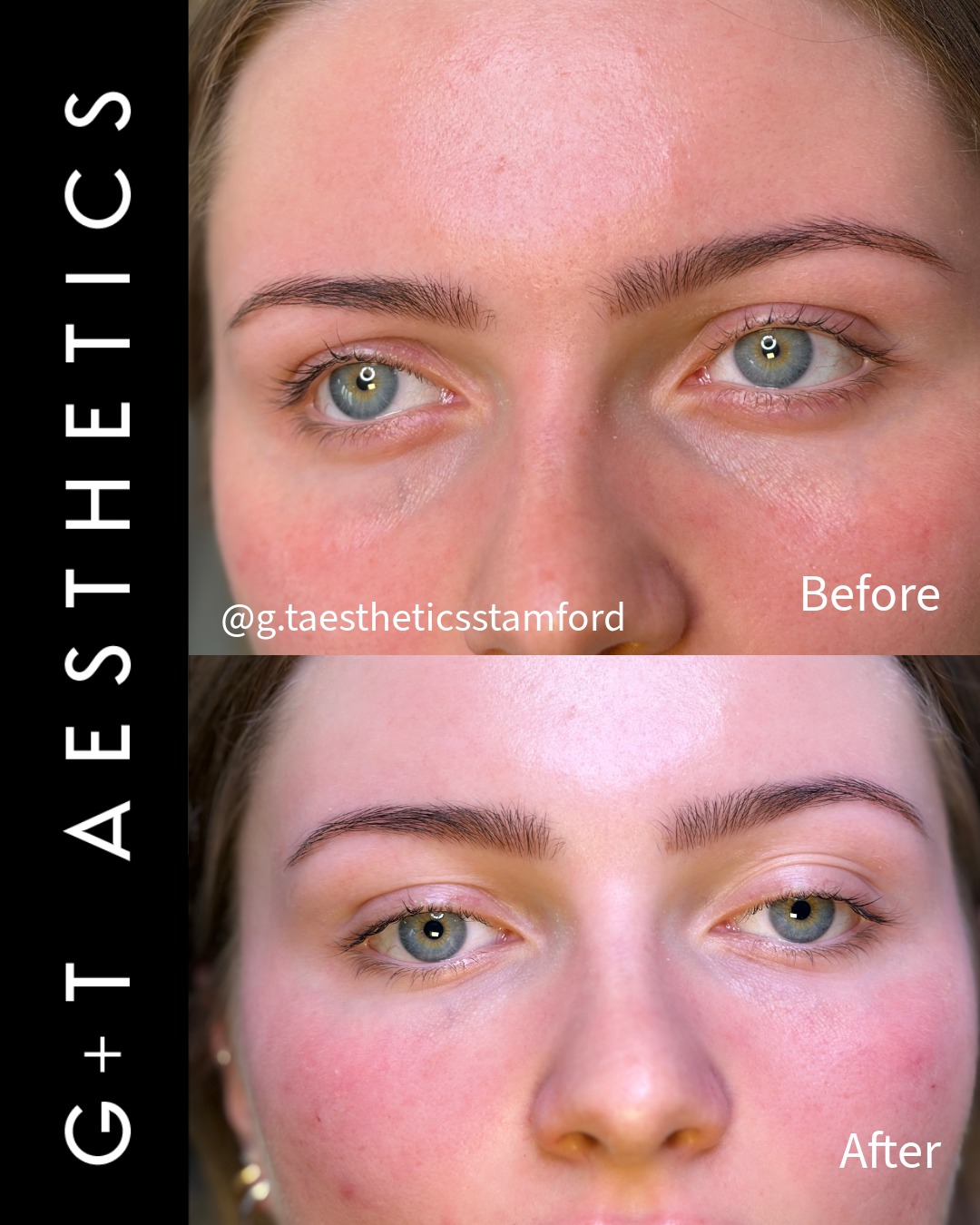 Under-eye rejuvenation, approached with precision.
Tear trough treatment restores volume beneath the eyes, reducing the appearance of hollowness and improving overall facial freshness.
📲Enquire or visit www.gtaesthetics.co.uk for more info.
#TearTrough #UnderEyeFiller #BeforeAndAfter #FacialRejuvenation #AestheticResults #GTAesthetics