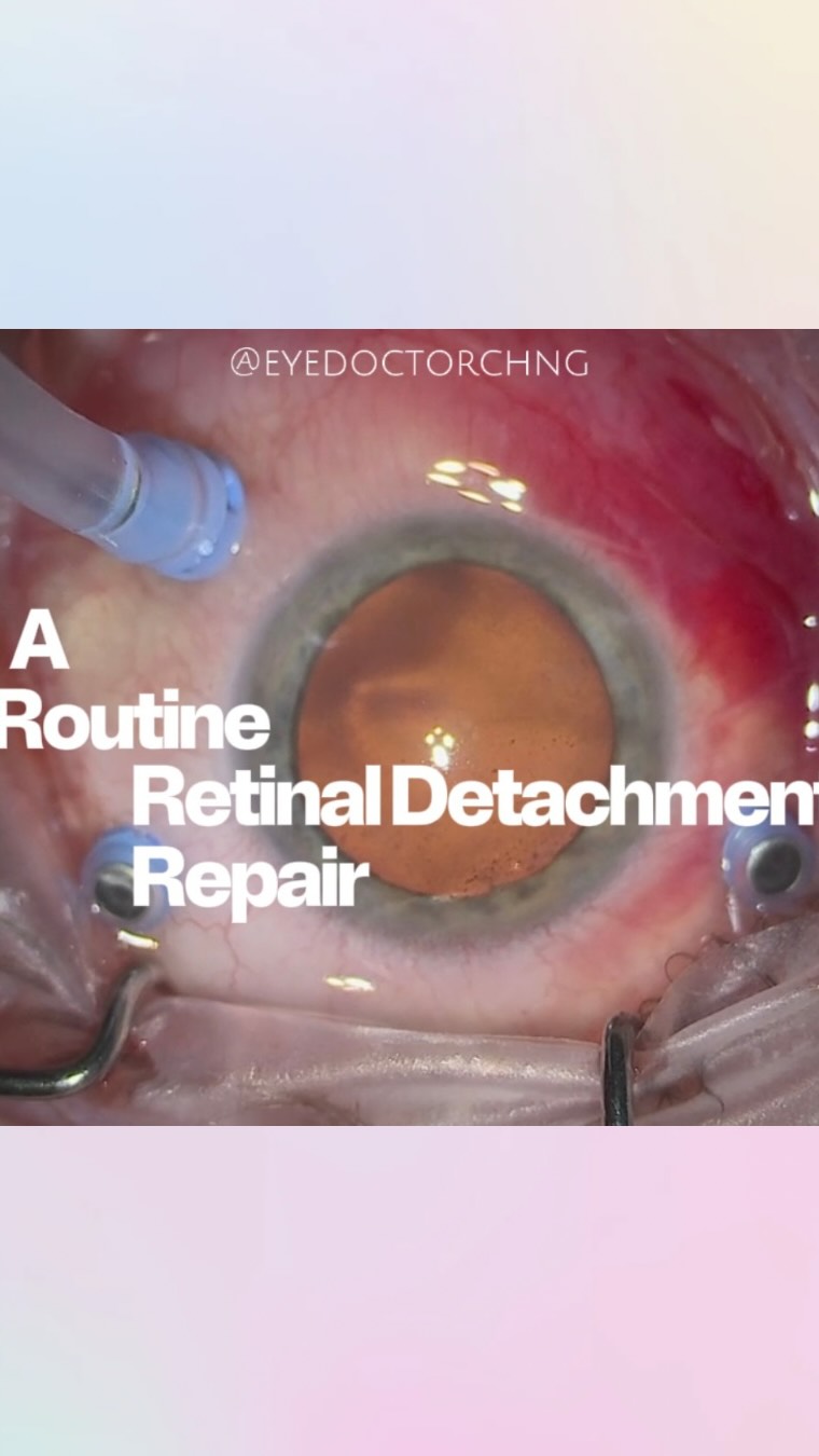 A routine retinal detachment surgery repair surgery with vitrectomy. Always satisfying to do.
Shoutout to our current VR fellow in BMEC @dspy8 in assisting with the case too!
#retinaldetachment #eyesurgery #vitreoretinalsurgery #ophthalmology #eyedoctorchng