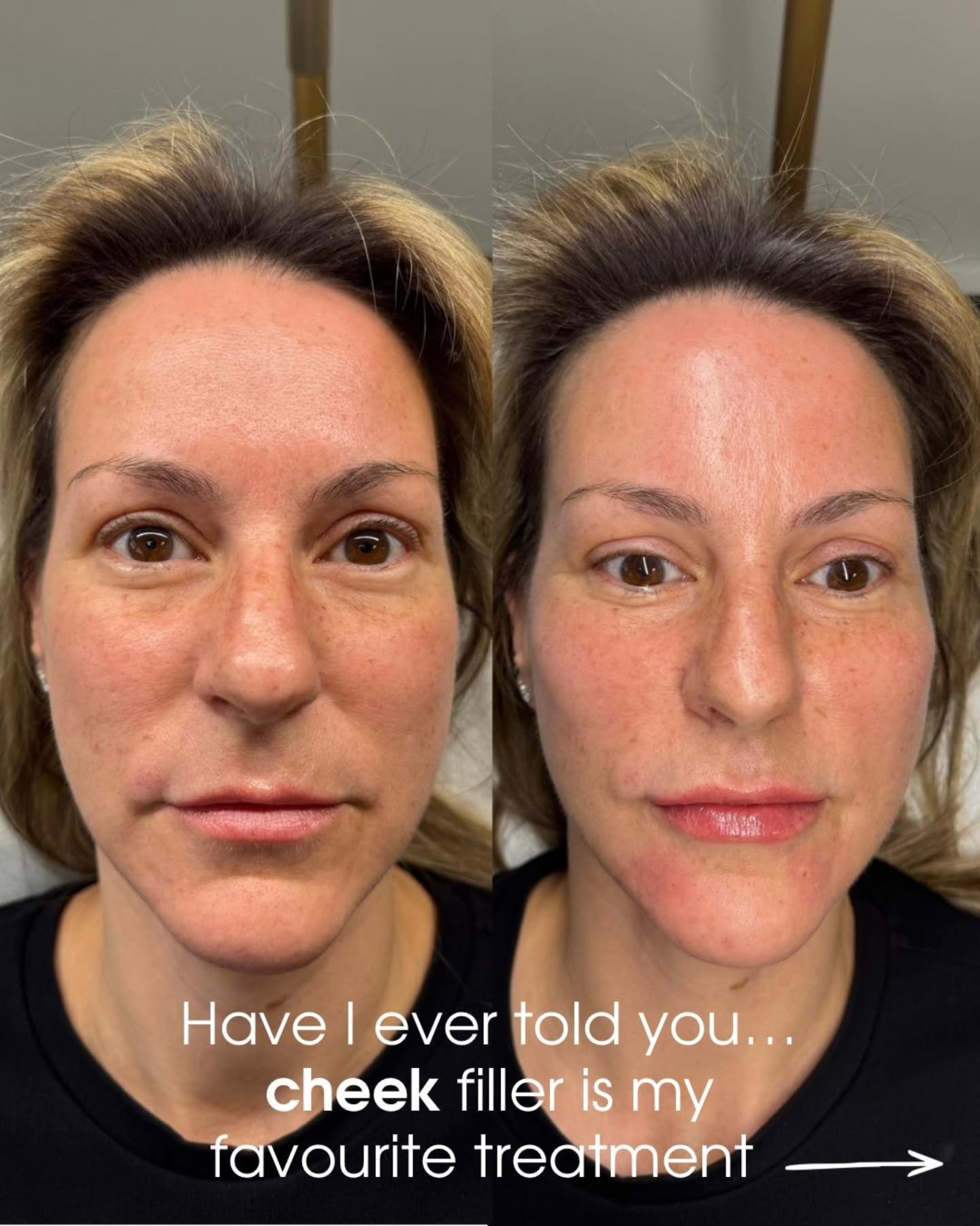 ✨ CHEEK FILLER DONE CORRECTLY CHANGES EVERYTHING ✨
One of my favourite treatments for a reason. 🤍
Cheek filler isn’t about making the face look “puffy” — it’s about restoring structure, balance and support where volume has been lost.
By restoring the cheeks correctly, we can:
• Lift the mid-face
• Soften heaviness around the lower face
• Improve facial proportions
• Enhance the side profile
• Create a fresher, more rested appearance
The best part? The results still look natural when it’s tailored properly to your face.
Subtle changes. Beautiful impact. 💫
DM “CHEEKS” for consultations or questions.
#cheekfillerswarrington #facialbalancing #aestheticswarrington #naturalresults #cheekfillers