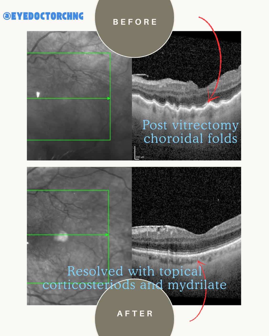Post vitrectomy hypotony without tamponade is reported to be around 6-22%. This is a case of post Yamane scleral haptic fixated intraocular lens (IOL) combined with 25G pars plana vitrectomy to remove a dislocated lens following trauma. Despite suturing the scleral ports and corneal wounds, the eye developed hypotony with choroidal folds as seen above. Vision was 6/60 Snellen and after ensuring there is no active leak, topical corticosteroids and mydrilate was given for a month. The eye pressure picked up and the vision is now 6/6 Snellen.
In these cases, if the hypotony persists, you have to check if the scleral wounds are truly closed and also ensure there is no cyclodialysis cleft formation from the Yamane IOL insertion.
#hypotony #choroidalfolds #yamaneiol #ophthalmology #eyedoctorchng