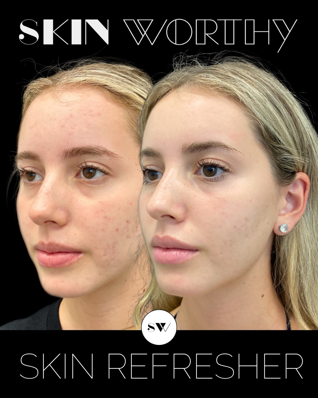 Healthy skin isn’t a one-time treatment - it’s a maintenance plan.
Our Skinergy Skin Refresher is one of our favourite treatments for supporting overall skin health while helping improve the look of texture, tone, hydration, and that fresh Skin Worthy glow.
This before & after is a perfect reminder that consistent skin maintenance matters — which is exactly why Skin Refreshers are part of our SW
Beauty Club.
The SW Beauty Club was designed for those who want to keep their skin healthy, strong, and glowing year-round with strategic, consistent treatments and thoughtful savings.
Want to learn more about the club or how to join?
Visit the link in bio or comment below.