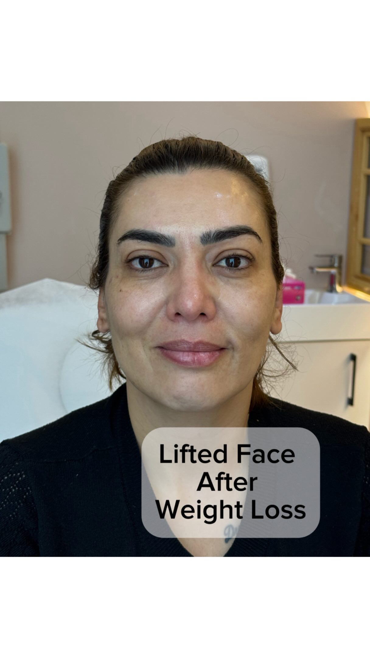 Endolift can be a great choice to correct and prevent skin laxity during weight loss , after pregnancy or just simply because of aging 🤌🏼
If you are a good candidate for Endolift, its results usually is remarkable ✅
.
.
.
#endoliftdubai #endolift