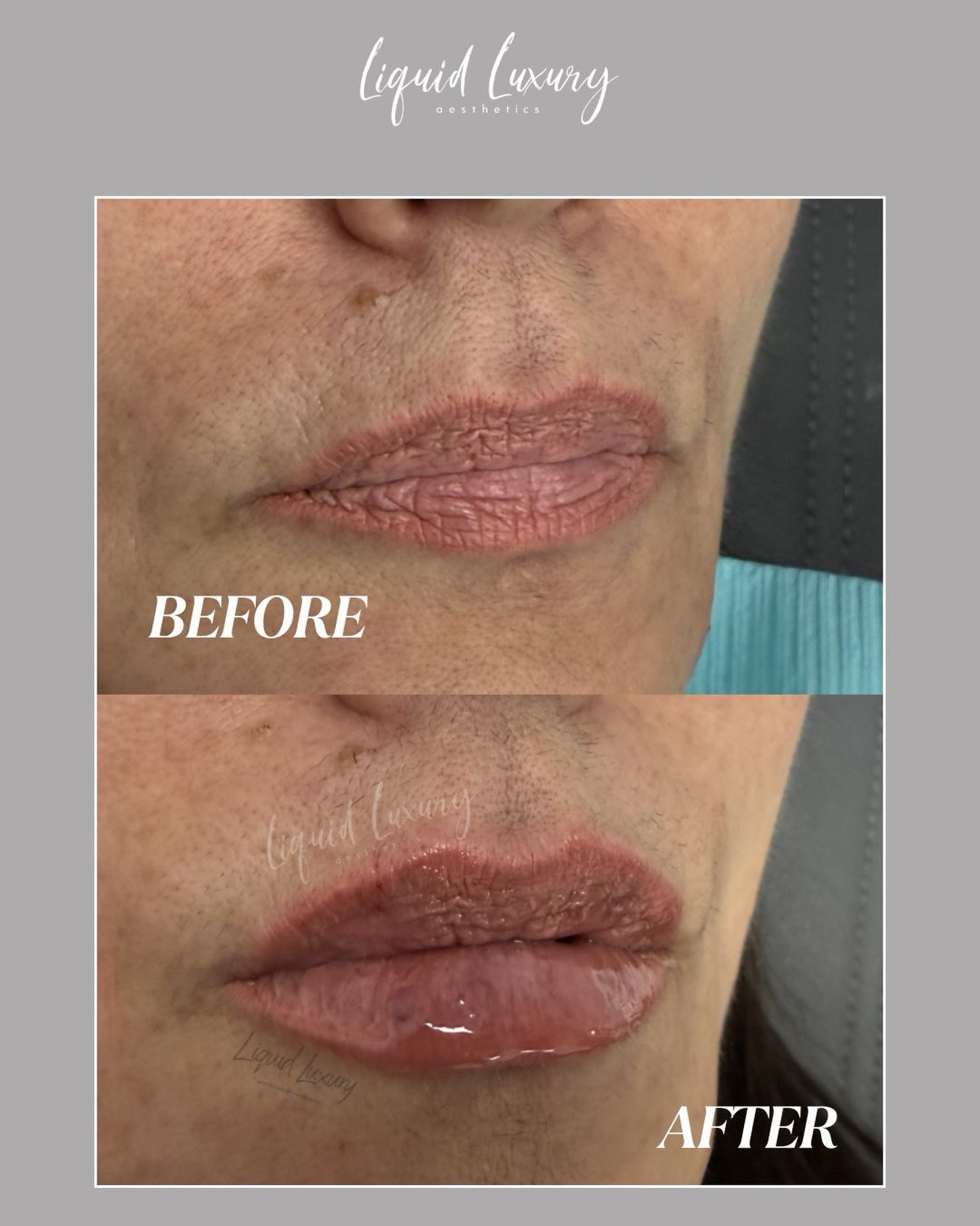 Soft, pillowy lips using 0.7ml of Restylane Kysse ๐
This filler is known for creating natural movement, soft volume, and beautifully defined lips without looking stiff or overfilled. Using less than a full syringe allowed us to subtly enhance shape and hydration while keeping everything balanced and effortless.
Natural looking results will always be in.
๐ (631)-760-1124
๐ www.liquidluxuryaesthetics.com
๐ 1030 W Jericho Tpke Suite 5 Smithtown, NY 11787
๐ง info@liquidluxuryaesthetics.com
๐ฉ๐ผโโ๏ธ Ina LaRocca-Tocco, FNP-C
๐คณ TikTok: liquidluxury_aesthetics
#RestylaneKysse #LipFiller #NaturalLips #LongIslandMedspa #LongIslandAesthetics