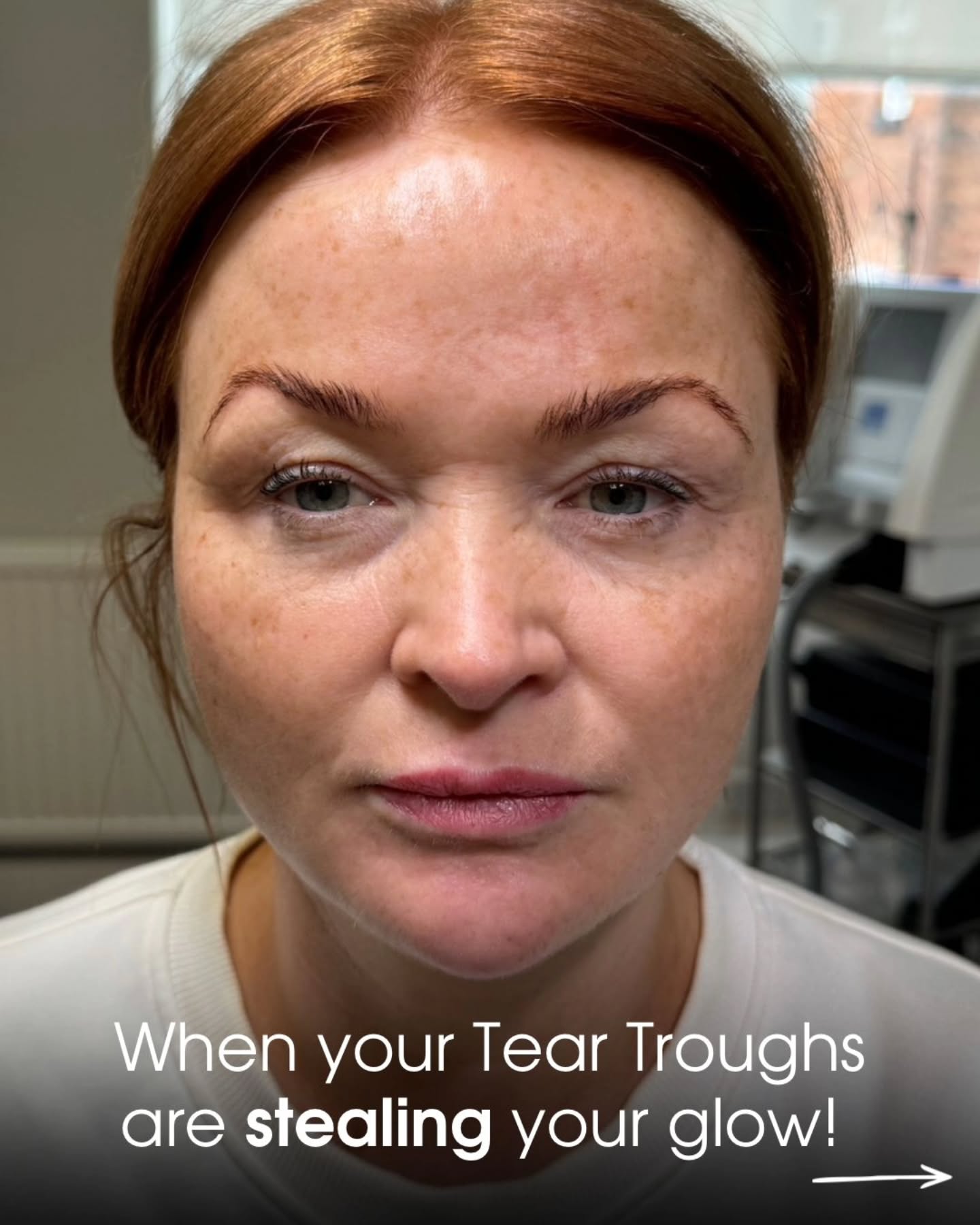 ✨ TEAR TROUGH REFRESH ✨
Those tired, shadowed under-eyes don’t always need a dramatic change… sometimes it’s the smallest tweak that makes the biggest difference. 💫
A refreshed tear trough can help you look: • Brighter
• Fresher
• More awake
• Naturally rejuvenated
The best compliment?
“You look really well” without anyone knowing exactly why 👏
Natural results will always be the goal
🤍
DM to book your consultation or to find out if tear trough treatment is right for you. ✨
#teartrough #teartroughfillerwarrington #naturalaesthetics #undereyefiller #aestheticswarrington