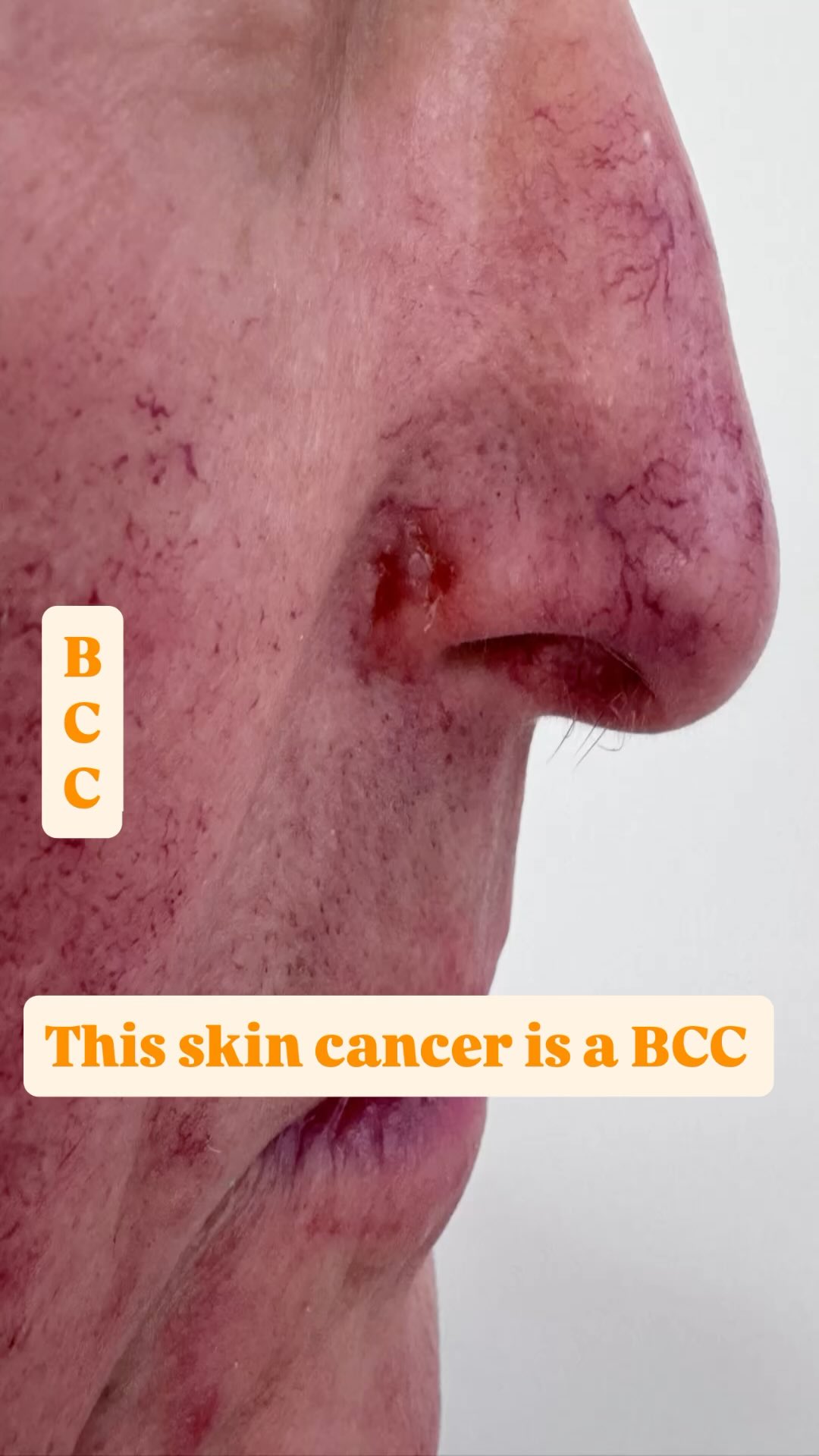 Sensitive content warning ⚠️
Please don’t scroll if you don’t want to see surgical images.
The reason I’m sharing this reel is to spread awareness about skin cancer and the importance of wearing SPF 50 daily.
Please pay closer attention to areas like:
• The edges and sides of the nose
• The ears
• The corners of the eyes
These are very common places we see BCCs and SCCs because suncream is often missed there.
BCC (Basal Cell Carcinoma) is the most common type of skin cancer found. People often say, “Oh it’s only a BCC.”
Having had a BCC myself, and now sharing my dad’s journey with a BCC too, I can honestly say… when you are the person going through it, it never feels like “just a BCC.”
My dad noticed his lesion early, but the NHS pathway was around 2 years for treatment. For mine I chose to pay privately and have MOHS surgery done sooner.
MOHS surgery is a specialist form of surgery usually performed on the face and is considered the gold standard for BCC removal. The tissue is checked there and then on the day to ensure full clearance whilst preserving as much healthy tissue as possible.
BCCs often grow slowly, sometimes around 1–2mm per year. The longer they are left, the more tissue may need to be removed.
Thankfully we have incredible consultants that can perform this type of surgery.
This post isn’t to scare people. It’s to create awareness.
Please pay attention to changes in your skin:
• A little pink or red patch that is new
• Something that bleeds, scabs, crusts or doesn’t heal
• A lesion that keeps coming back
• Something that hasn’t gone away after a month or so
Get it checked.
You can speak to your GP, or if you would like faster access to a consultant dermatology opinion, we also offer a Mole & Lesion Screening service in clinic with reports usually returned within 2–48 hours from leading consultant dermatologists.
Early detection and action matters. 🤍
#SkinCancerAwareness #BCC #BasalCellCarcinoma #MohsSurgery #SPF50 WearSPF SkinHealth SkinCancer EarlyDetection MoleCheck SkinClinic TheExpertSkinClinic SkinAwareness Dermatology SkinCancerPrevention CheckYourSkin SPFEveryday SunProte