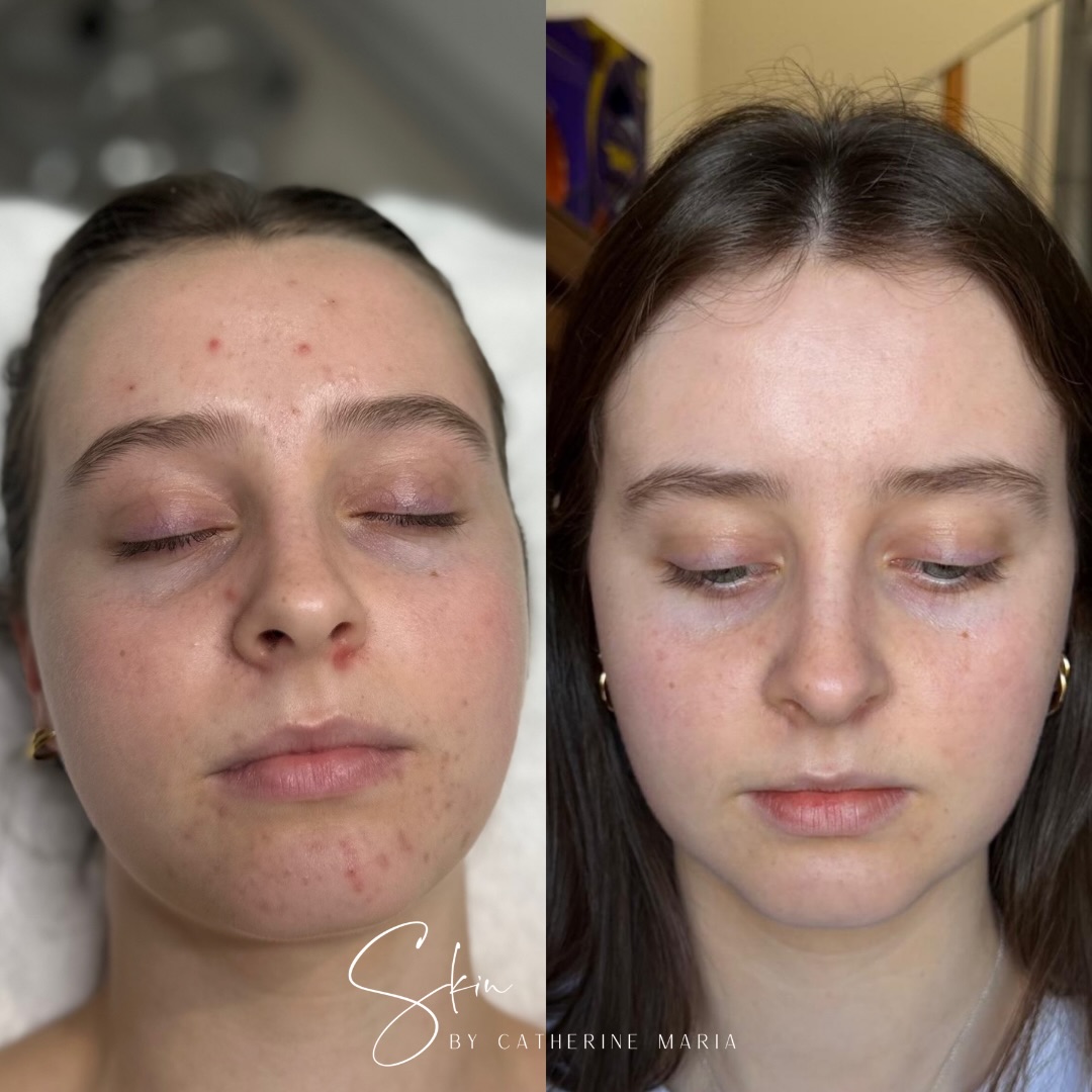 This beautiful before and after is a reminder that more products doesn’t always mean better results.
When Elsie first came to me, her skin was inflamed, reactive and congested and her skin barrier was struggling. She was using too many active products and over-exfoliating.
Instead of stripping the skin back aggressively, we focused on rebuilding and supporting it properly. We simplified her skincare routine (making sure we incorporated a broad-spectrum SPF and using it consistently), and using a cleanser and moisturiser that actually suited her skin type/concern.
We also made realistic lifestyle adjustments that also made a huge difference to her skin. We reduced highly processed snacks, increased protein at breakfast to help blood sugar balance, improving hydration and focused on being consistent.
If your skin feels angry, reactive or you feel like nothing is working, sometimes doing less (but doing it correctly) changes everything.
A huge thank you to the knowledge and education from @functionalskinacademy for continuing to deepen my understanding of the connection between skin health, lifestyle, nutrition and the skin barrier. It’s completely changed the way I approach treating skin.
📍 Aylesbury, Buckinghamshire
📩 info@skinbycatherinemaria.com
🤍 www.skinbycatherinemaria.com
#aylesbury #aylesburybusiness #aylesburytown #aylesburyvale #buckinghamshirebusiness