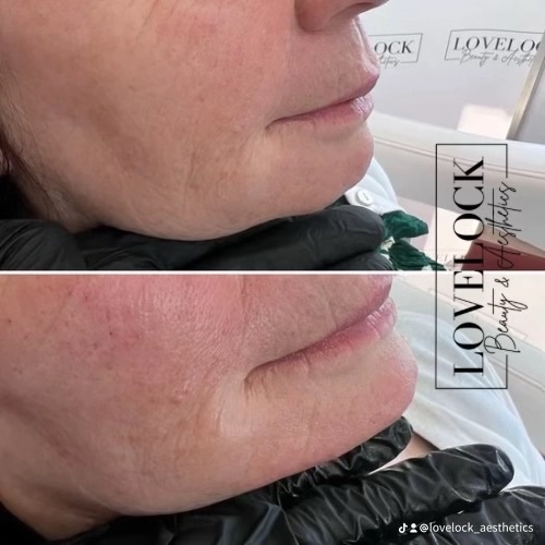✨ Facial Sculpting ✨
Enhance your natural features with non-surgical facial sculpting designed to create balance, definition, and a beautifully refreshed appearance. From contouring the jawline and cheeks to restoring volume and structure, treatments are tailored to complement your unique facial anatomy.
Benefits of Facial Sculpting:
• Enhanced facial definition & contour
• More balanced, symmetrical features
• Restored volume & youthful appearance
• Sharper jawline and lifted profile
• Natural-looking results with minimal downtime
• Boosted confidence and refreshed appearance
Subtle enhancements. Beautiful results. 💉✨
#warminster #westbury #melksham #frome #trowbridge