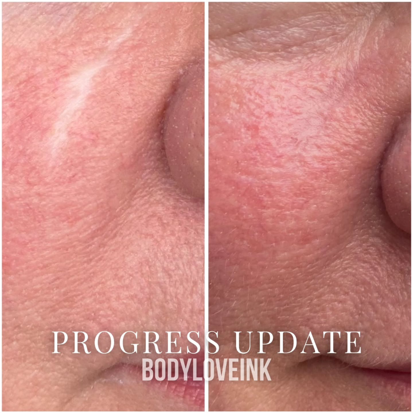 I love seeing healed work in the wild! We’re still working on the nose scar and will update with pictures when she’s in again
MOHS: Micrographic surgery, highly precise skin cancer surgery
Stay tuned for next update and DM us for questions or inquiries.
Link in bio
📍2588A Yonge Street, Unit 106, 2nd Floor
Toronto, Ontario M4P 2J3
📧 bodyloveink@gmail.com
#Bodyloveink #mohs #mohssurgery
#dermatologist #scarcamouflage