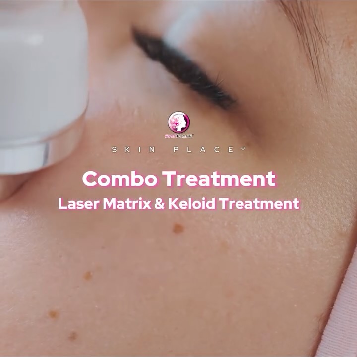 Take control of your skin with our Combo Scar Treatment! 🧬✨
We combine the power of Laser and Keloid Treatment for a comprehensive approach to scar management. Here’s how it works:
1️⃣ Flatten & Soften: Specifically targets raised keloids for a smoother surface.
2️⃣ Resurface: Laser Matrix minimizes roughness and refines texture.
3️⃣ Even Tone: Reduces dark pigmentation around the scar area.
4️⃣ Long-term Control: Injections help prevent the keloid from returning.
5️⃣ No Surgery: A safe, minimally invasive alternative to surgical removal.
Ready to start your journey to smoother skin? Send us a message! 💌
📍 Skin Place: Your Skin’s Place.
✨ See comment section for more details! ✨
#SkinPlace #KeloidTreatment #LaserMatrix #ScarRemoval #SkinCareExpert #NonSurgical
