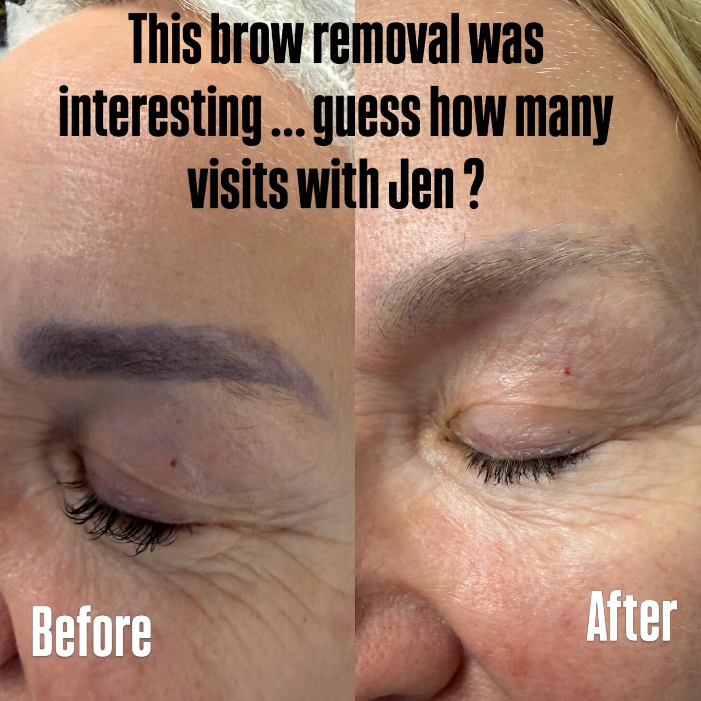 This was an interesting one! Just 1 session with Jen 6 weeks of her brows metabolizing and she’s back for her second session! They will continue to metabolize! ThankYou @studiokanti for trusting me with your clients brows and skin!