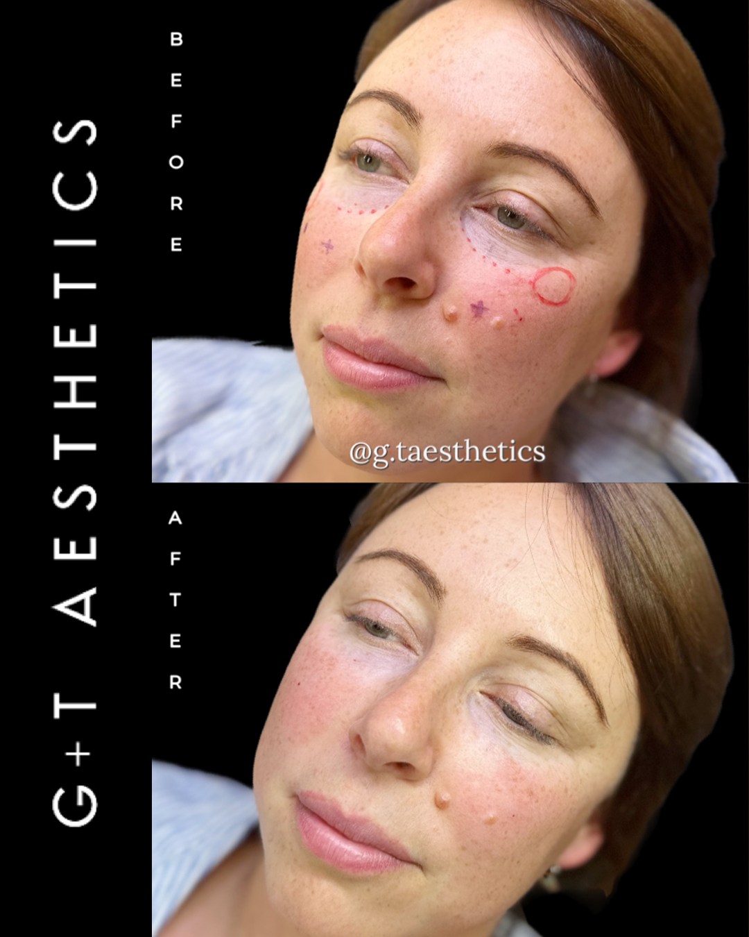 A refreshed under-eye appearance can make a significant difference to the overall face.
Tear trough filler is designed to reduce hollowness beneath the eyes, creating a smoother and more rested look while maintaining natural facial balance.
📲Enquire or visit www.gtaesthetics.co.uk for more info.
#TearTrough #UnderEyeFiller #BeforeAndAfter #FacialRejuvenation #AestheticClinic #NaturalResults #GTAesthetics