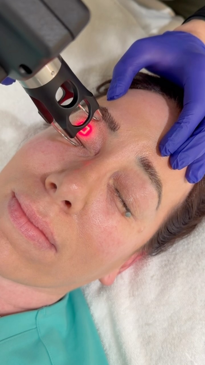 What is a non-surgical bleph? 👁️✨
This treatment uses a CO2 laser to tighten and resurface the delicate skin around the eyes, helping improve crepey texture, fine lines, and mild hooding with little to no surgery required.