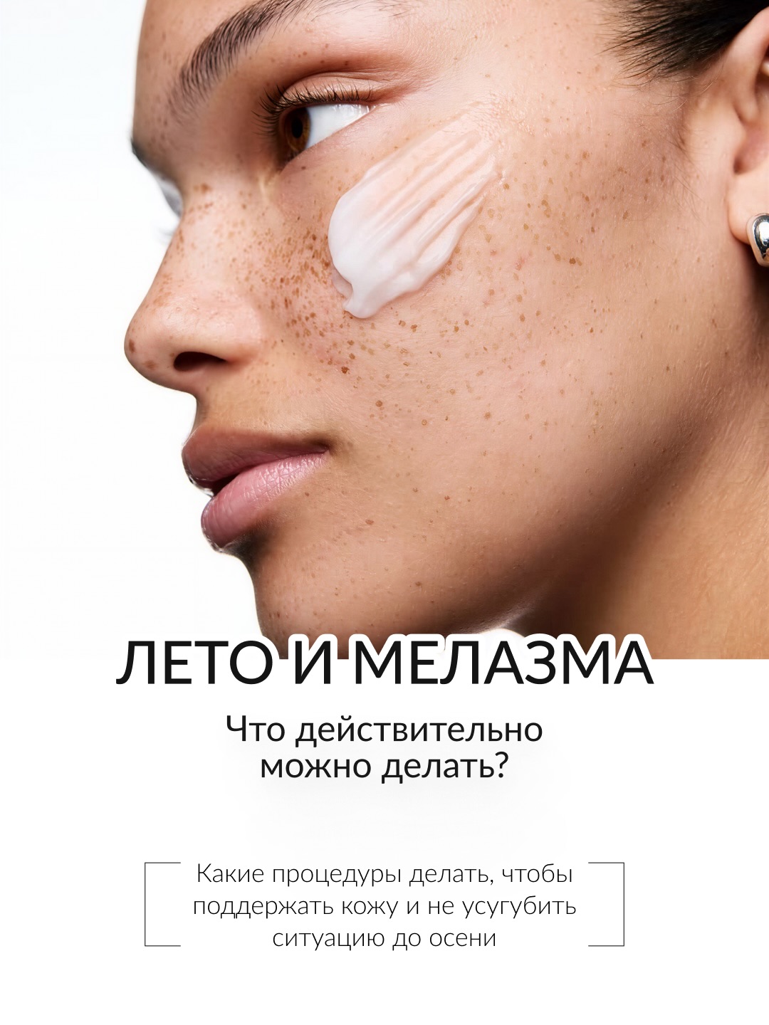 During summer, we avoid all aggressive protocols when working with pigmentation (especially melasma).
During periods of high sun exposure, the skin becomes much more sensitive to any additional inflammation, while the risk of pigmentation flare-ups increases.
So what should you do in summer to support your skin and avoid worsening the condition before autumn? Besides SPF, which is essential for melasma all year round.
Our specialists shared their recommendations — swipe through the carousel 👆