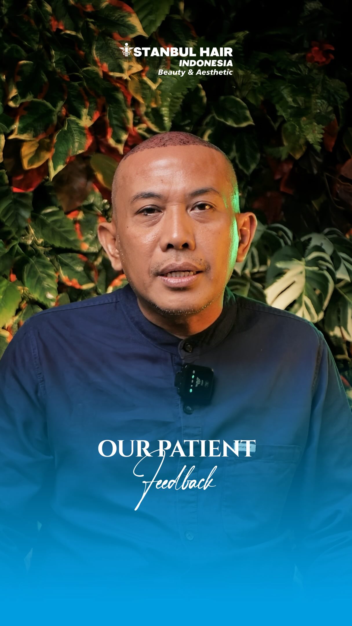 4800 grafts untuk perubahan yang terlihat natural sejak awal ✨
Pasien asal Bandung ini menjalani prosedur hair transplant di Istanbul Hair Indonesia dengan desain hairline yang disesuaikan agar tampak lebih tegas, proporsional, dan tetap natural.
Detail placement yang presisi menjadi kunci untuk hasil yang clean dan seamless.
—
4800 grafts for a naturally refined transformation ✨
Our patient from Bandung underwent a hair transplant procedure at Istanbul Hair Indonesia with a customized hairline design created to look defined, balanced, and natural.
Precise graft placement plays an important role in achieving a clean and seamless result.
#IstanbulHairIndonesia #HairTransplantIndonesia #4800Grafts #FUEHairTransplant #NaturalHairline