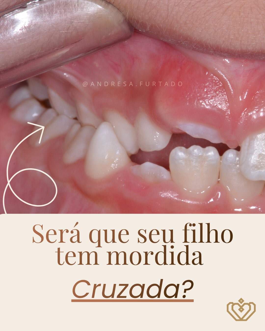 Será que seu filho tem mordida cruzada?
Neste carrossel mostramos a evolução de um caso da nossa ortodontista Dra. Andresa Furtado: início, fase com aparelho expansor e resultado final ✨
Observar a mordida das crianças desde cedo faz toda diferença no desenvolvimento do sorriso 💙